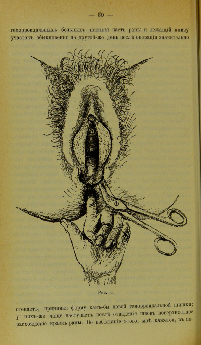 геморроидальныхъ болыіыхъ нижняя часть раны и ложащій книзу участокъ обыкновенно на другой-же день послѣ онеращи значительно Рис. 1. отекаетъ, принимая форму какъ-бы новой геморроидальной шишки; у нихъ-же чаще наступастъ послѣ отпаденія швовъ поверхностное расхожденіе краевъ раны. Во избѣжаніе этого, мнѣ кажется, въ до-