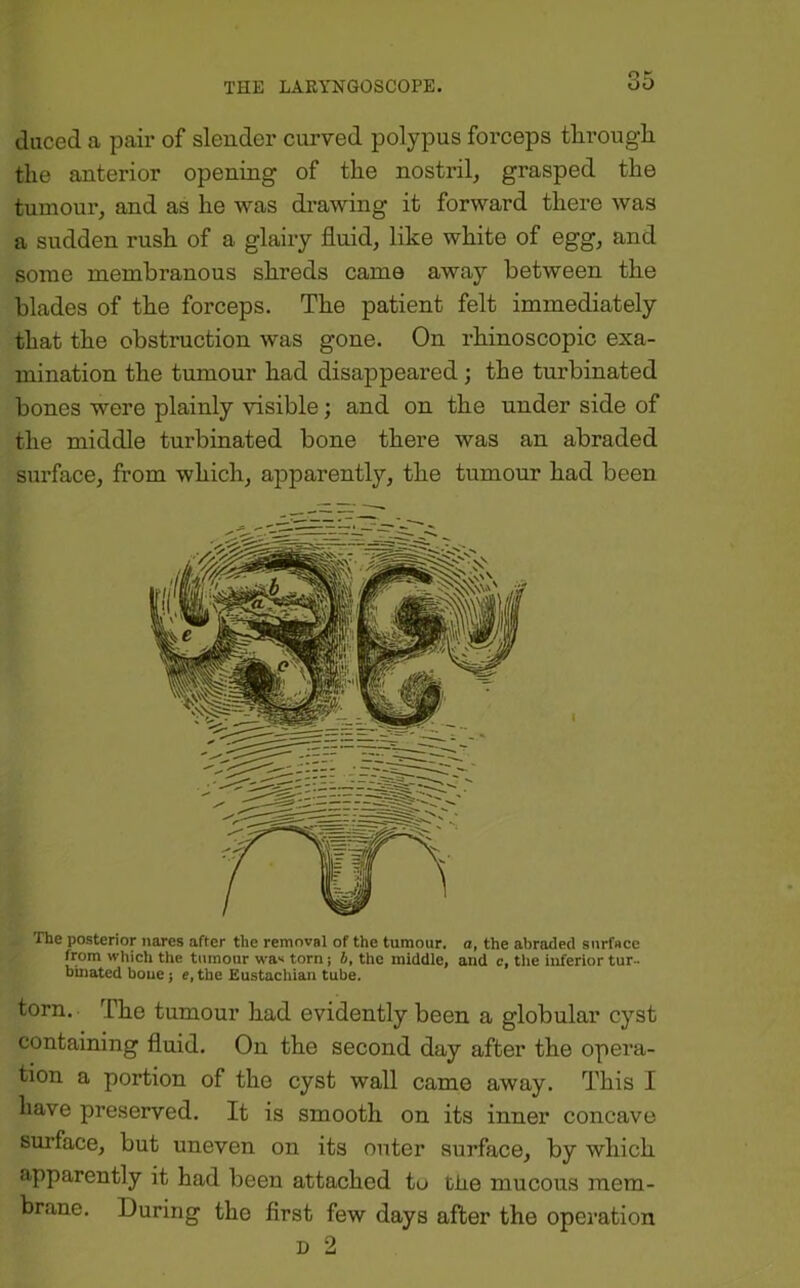 (liiced a pair of slender curved polypus forceps through the anterior opening of the nostril^ grasped the tumoui’, and as he was drawing it forward there was a sudden rush of a glairy fluid, like white of egg, and some membranous shreds came away between the blades of the forceps. The patient felt immediately that the obstruction was gone. On rhinoscopic exa- mination the tumour had disappeared; the turbinated bones were plainly visible; and on the under side of the middle turbinated bone there was an abraded surface, from which, apparently, the tumour had been The posterior nares after the removal of the tumour, a, the abraded surface from which the tumour wa'* torn; b, the middle, and c, the inferior tur- binated bone; e, the Eustachian tube. torn. The tumour had evidently been a globular cyst containing fluid. On the second day after the opera- tion a portion of the cyst wall came away. This I have preserved. It is smooth on its inner concave surface, but uneven on its outer surface, by which apparently it had been attached to tiie mucous mem- brane. During the first few days after the operation
