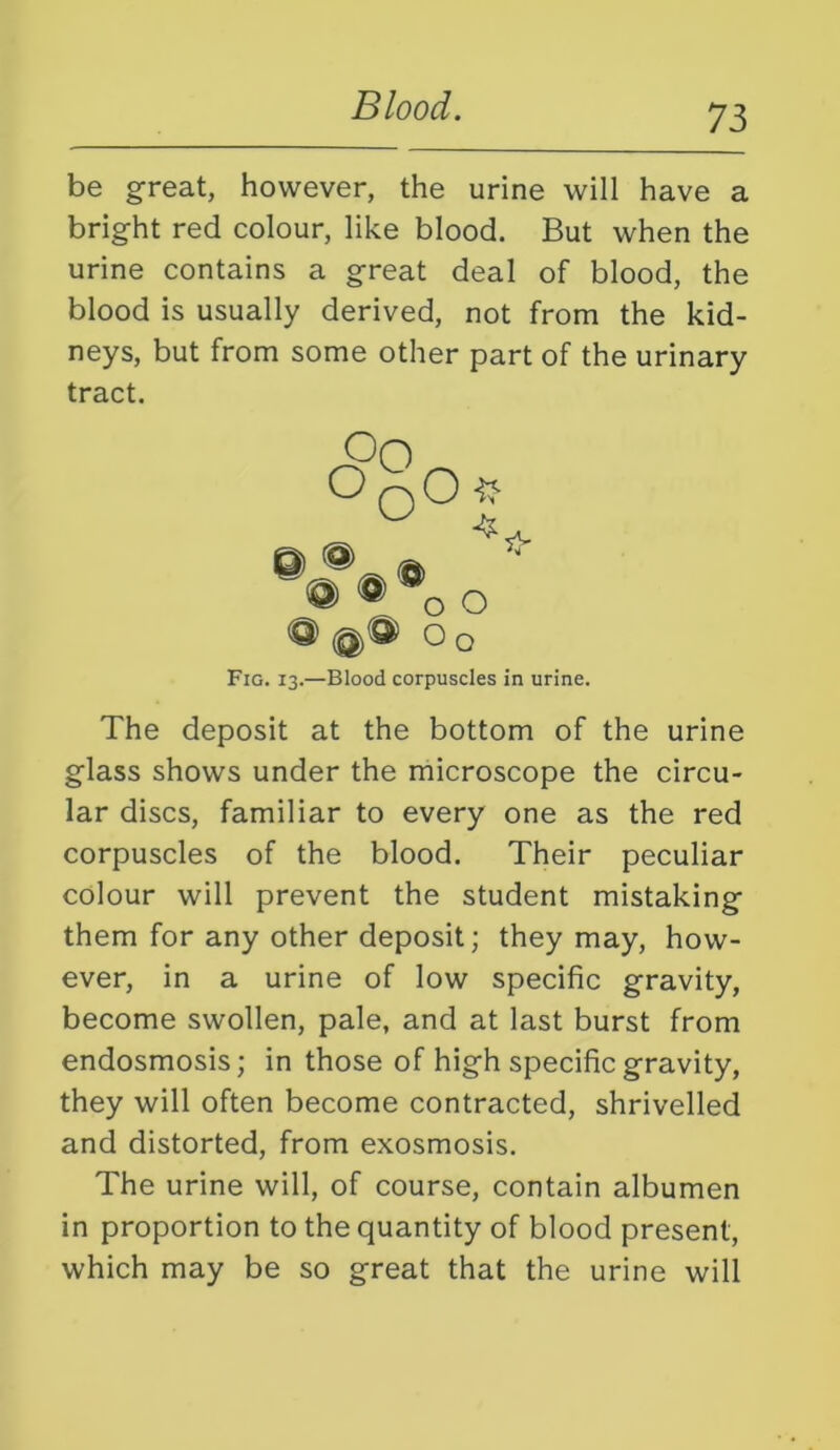 be great, however, the urine will have a bright red colour, like blood. But when the urine contains a great deal of blood, the blood is usually derived, not from the kid- neys, but from some other part of the urinary tract. Oo o o O @ Q O Oo Fig. 13.—Blood corpuscles in urine. The deposit at the bottom of the urine glass shows under the microscope the circu- lar discs, familiar to every one as the red corpuscles of the blood. Their peculiar colour will prevent the student mistaking them for any other deposit; they may, how- ever, in a urine of low specific gravity, become swollen, pale, and at last burst from endosmosis; in those of high specific gravity, they will often become contracted, shrivelled and distorted, from exosmosis. The urine will, of course, contain albumen in proportion to the quantity of blood present, which may be so great that the urine will