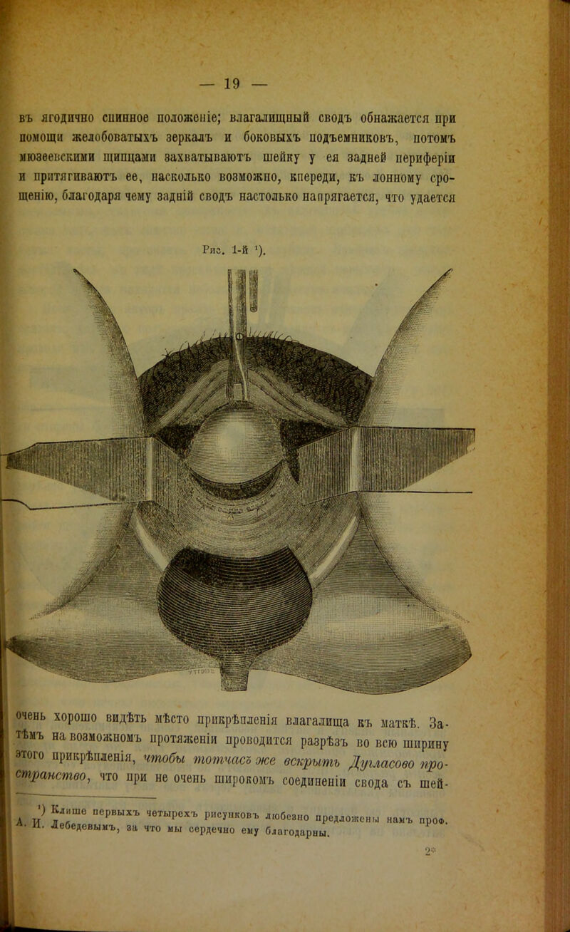 |іъ ягодично сииеное положепіе; влагалищный сводъ обнажается при іомощц жѳлобоватыхъ зеркалъ и боковыхъ подъемниковъ, потомъ іюзвеііскими щипцами захватываіотъ шейку у ея задней периферіи ирнтягиваютъ ее, насколько возможно, кпереди, къ лонному сро- [^щенію, благодаря чему задній сводъ настолько напрягается, что удается Рис. І-Й 1), очень хорошо видѣть мѣсто прикрѣпленія влагалища къ маткѣ. За- тѣмъ на возможномъ протяженіи проводится разрѣзъ во всю ширину этого прикрѣпленія, чтобы шотчасъ же вскрыть Дугласово про- странство, что при не очень широкомъ соединеніи свода съ шей- А и іТ^ Р'-'^У'^^^-ь ^'«бевно предложены „а«ъ проФ. л. И. Дебедевыиъ, за что мы сердечно ему благодарны. о*