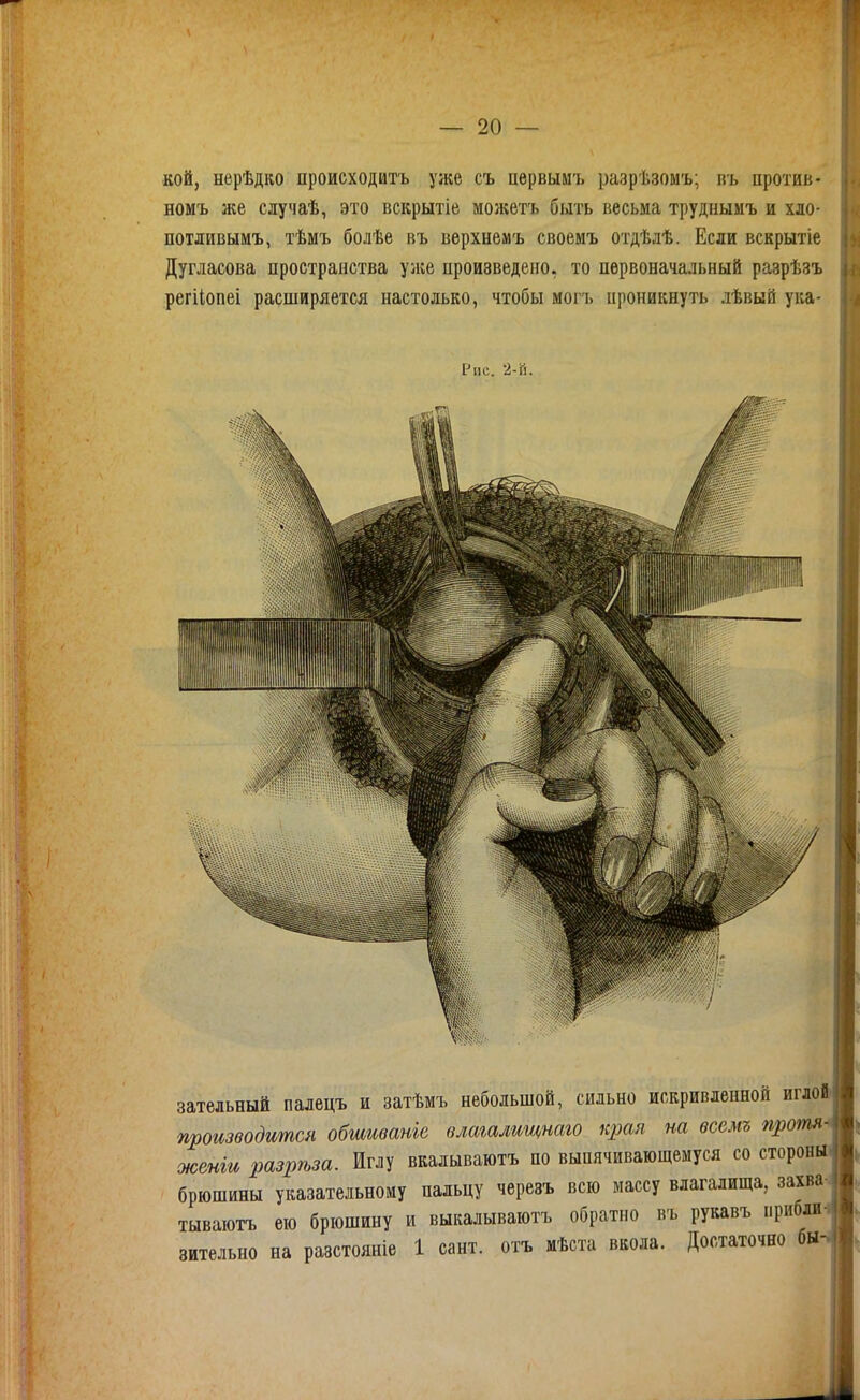 кой, нерѣдко происходитъ уже съ первымъ разрѣзомъ; въ цротив- номъ же случаѣ, это вскрытіе можетъ быть весьма труднымъ и хло- потливымъ, тѣмъ болѣе въ верхнемъ своемъ отдѣлѣ. Если вскрытіе Дугласова пространства уіке произведено, то первоначальный разрѣзъ регііопеі расширяется настолько, чтобы могъ проникнуть лѣвый ука- Рнс. 2-й. зательный палецъ и затѣмъ небольшой, сильно искривленной иглоЁ' производится обшивате влагалищнаго края на осемъ протя женги разрѣза. Иглу вкалываютъ по выпячивающемуся со стороны брюшины указательному пальцу черезъ всю массу влагалища, захва-. тываютъ ею брюшину и выкалываютъ обратно въ рукавъ прибли- зительно на разстояніе 1 сант. отъ мѣста вкола. Достаточно бы