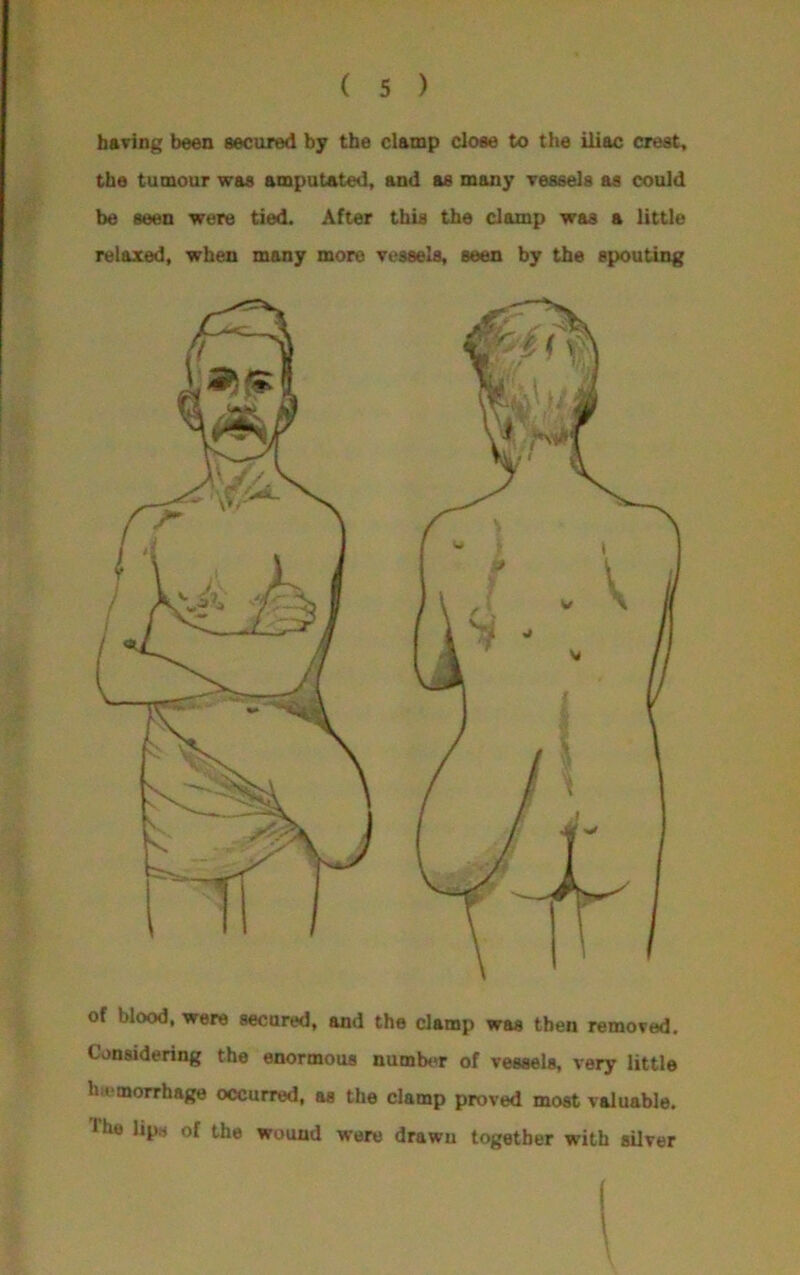 having been secured by the clamp close to the iliac crest, the tumour was amputated, and as many vessels as could be seen were tied. After this the clamp was a little relaxed, when many more vessels, seen by the spouting of blood, were secured, and the clamp was then removed. Considering the enormous number of vessels, very little he morrhage occurred, as the clamp proved most valuable. Ihe lips of the wound were drawn together with silver