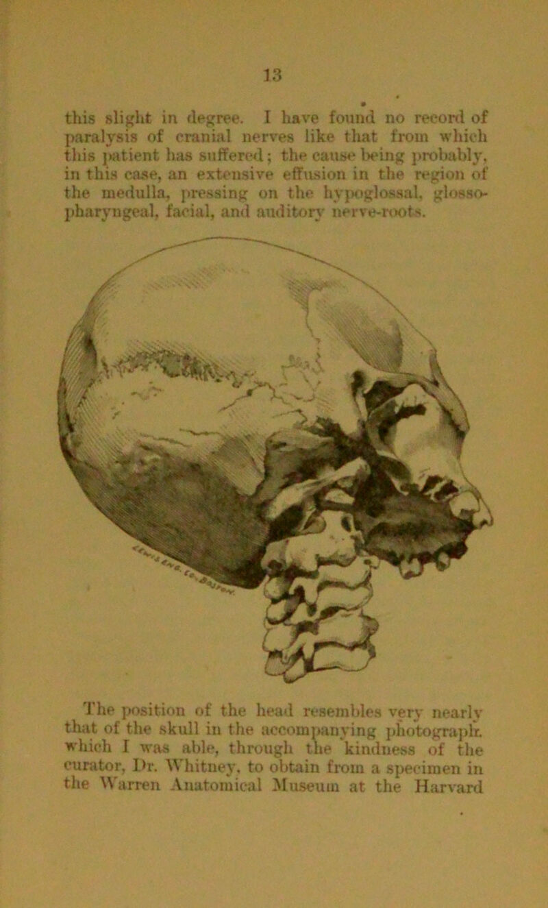 this slight in degree. I have found no reeonl of j)aralysi8 of cranial nerves like that from which this ]»atient has suffered; the cause being j>robably, in this case, an extensive effitsion in the rt^gion of the medulla, pre.ssing on the hyp<.iglossal. gh^sso pharyngeal, facial, and auditory nerve-nx)ts. 'J'he position of the head resembles very nearlv that of the skull in the accompanying photograj)!^ which I wius able, through the kindness of the curator. Dr, Whitney, to obtain from a specimen in the Warren Anatomical Iduseuin at the Harvard