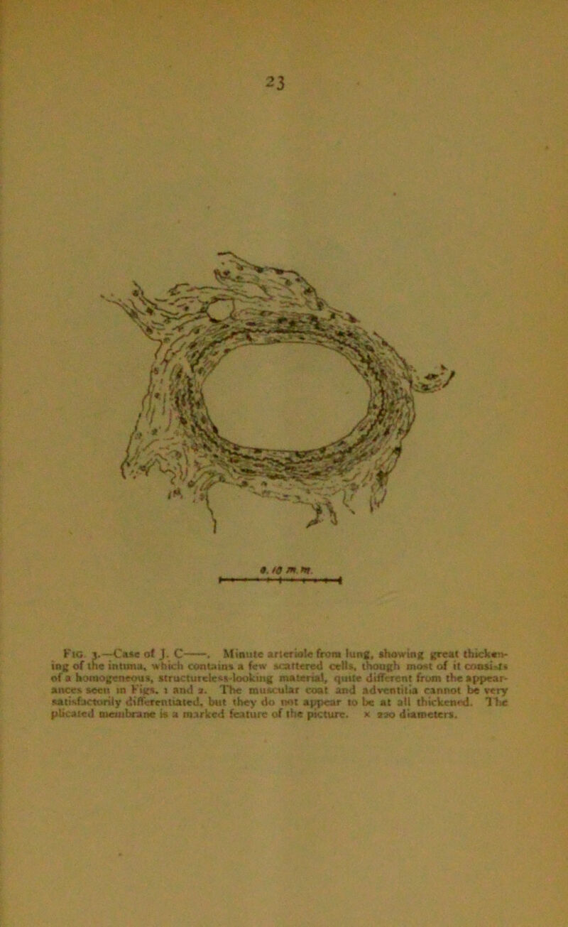 Fig. j.—Case of J. C-—. Minute arteriole from lung, thawing great thicken- ing of the intuna, which contain* a few scattered crUt, tl^gh moot of it couistt of a bomogeneoui, tlruciutele*>-looking material, quue different from the appear- ances s«en m Kigs. i and a. The muscular coat and adrentilia cannot be eery aatisfacturily differentiated, but the>' do ml appear to be at all thickened. Ifie plicated meuibranc is a marked feature of the picture, x tao diametert.