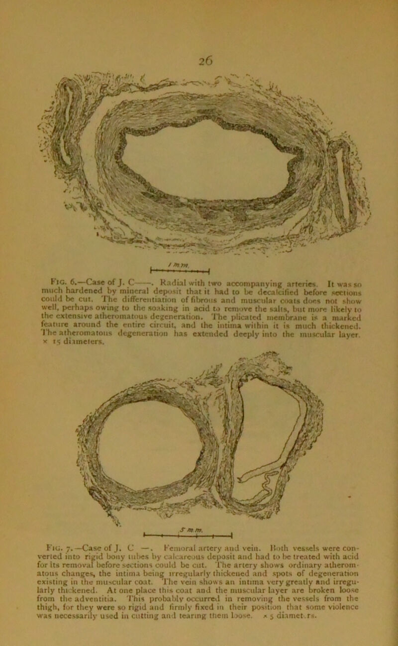 , / m-m. H--' ...< FIC. 6.—Caie of J. C . Radial with two accompanying arteries. It wax so much hardened by mineral deposit that it had to be decalcified before sectionx could be cut. 1 he differentiation of filirous and muscular coats does not show well, perhaps owing to the soaking in acid to remove the salts, but more likely to the extensive atheromatous degeneration. 'ITie plicated membrane is a marked fixture around the entire circuit, and the intima within it is much thickened. I he atheromatous degeneration has extended deeply into the muscular layer. X 15 ditinelers. Fig. 7.—Case of J. C —. Femoral artery and vein. 1 loth vessels were con- vened into rigid bony lubes by calcareous deposit and had to be treated with acid for Its removal before sections could be cut. The artery shows ordinary atherom- atous changes, the intima bein^ irregularly thickened and .spots of degeneration existing in the muscular coat. The vein shows an intima very greatly and irregu- larly thickened. At one place this coat and the muscular layer are broken loose from the adventitia. This probably occurred in removing the vessels from the thigh, for they were so rigid and firmly fixed in their position that some violence was necessarily used in cutting and tearing them loose, x 5 diamet.rs.
