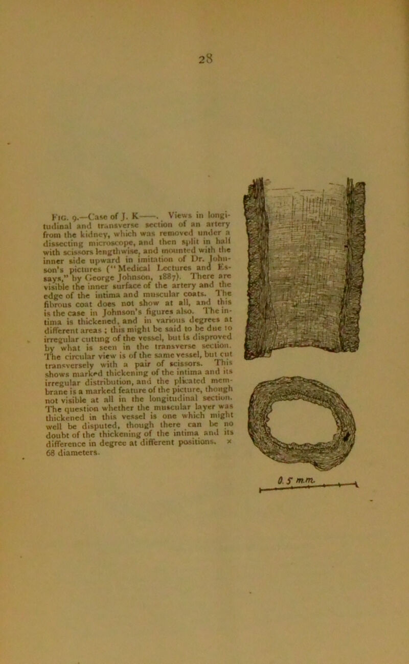 Kig. q.—CaMsof J. K . View* in longi- liiilinal anj truniverse »eclion of an artery from the kidney, which was removed under a dissecting microscope, and then s|>lit in half with scissors lengthwise, and mounted with the inner side upward in imitation of Dr. lohii- son’s pictures (Medical futures and Ks- says,” by George Johnson, 1887). There are visible the inner surface of the artery and the edge of the intima and muscular coals. The fibrous coat does not show at all, and this is the case in Johnson’s figures also. The in- tima is thickened, and in various degree* at different areas ; this might be said to due to irregular ciittmg of the vessel, but Is disproved by what is seen in the transverse section. The circular view is of the same vessel, but cut transversely with a pair of scissors. This shows marked thickening of the intima and its irregular distribution, and the plicated mem- brane is a marked feature of the picture, though not visible at all in the longitudinal section. The question whether the muscular layer was tliickened in this vessel is one which might well be disputed, though there can be no doubt of the thickening of the intima and it* difference in degree at different positions, a 68 diameters.