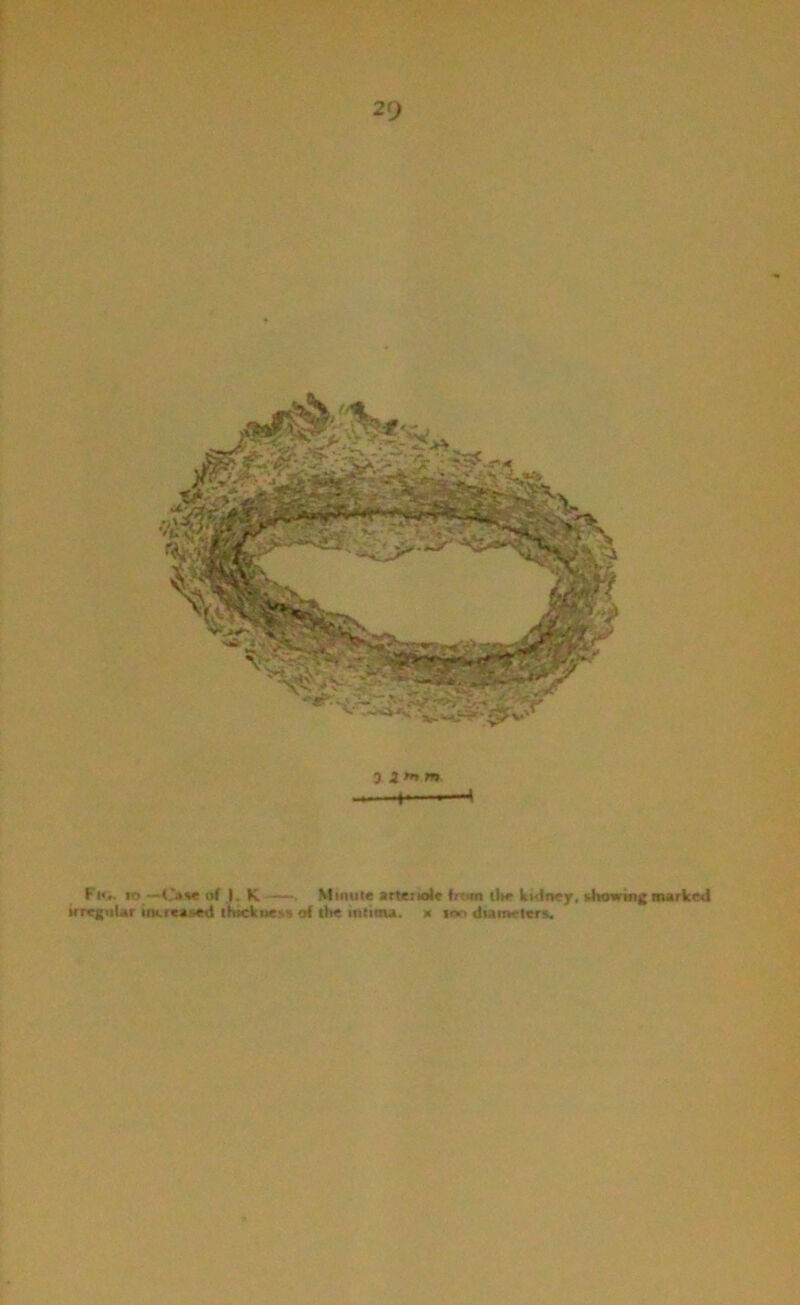 0 2 fnm. H——* Fk». m —C»%t of ,1. K . Mintile artciioi« frt«n tlir ki-dney, khowinc Burked irrc{iiUr iiKrcaiied lhickne^s of the intinu. x ten diameters.