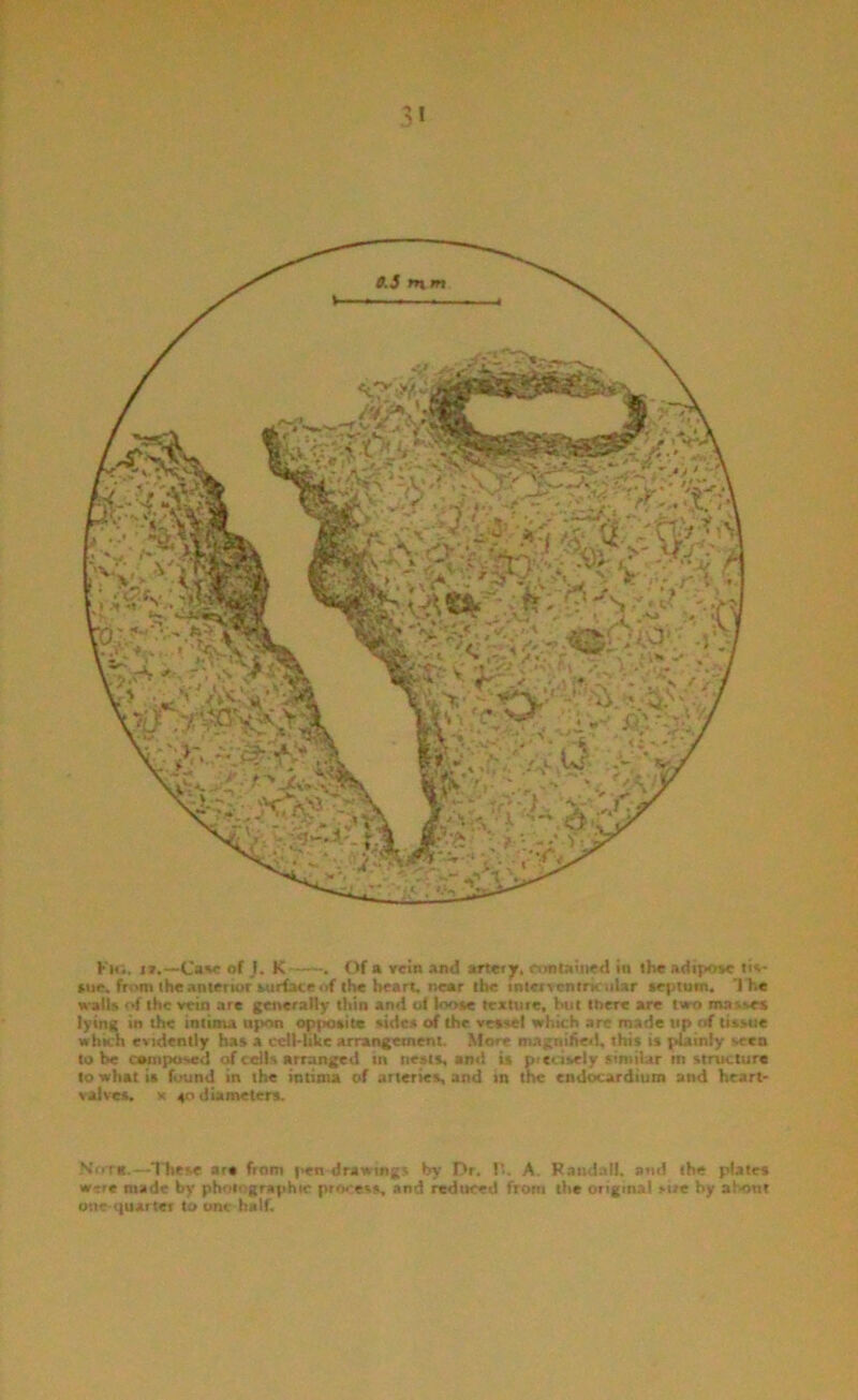 Ki4i. !»♦—*Ca^c of j. K——Of ft vcm and artery, nmuined in ihe adipoae sue. fnmuheanterior auriace4if the heart, near the mtcrventrK uUr septum. Ihe waits of the vein are generally thin and oi loose texture, but there are two masNes lying in the iminu upon opfiositc sides of the vessel which are made up of tissue which evidently has a celhlikc arra^ement. More magnihet!, this is ptainly vceo to he composed of ce)K arranged in nests, and is precisely similar in structure to what is (bund in the intima of arteries and in the endocardium and heart> valves. V 40 diameters. No ra.—These are from |>en drawings by Dr. 1*. A. Randall, ami the plates w«re made by photographic prry'ess, and reduced from the original M/e by al^ont one (quarter to urn- half.
