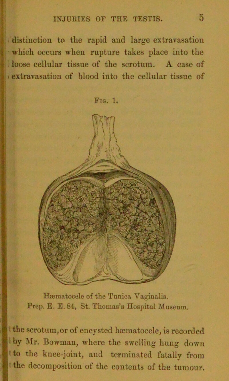 distinction to the rapid and large extravasation which occurs when rupture takes place into the loose cellular tissue of the scrotum. A case of i extravasation of blood into the cellular tissue of Fig. 1. Htematocele of the Tunica Vaginalis. Prep. E. E. 84, St. Thomas’s Hospital Museum. the scrotum,or of encysted hoematocele, is recorded by Mr. Bowman, where the swelling hung down to the knee-joint, and terminated fatallv from the decomposition of the contents of the tumour.