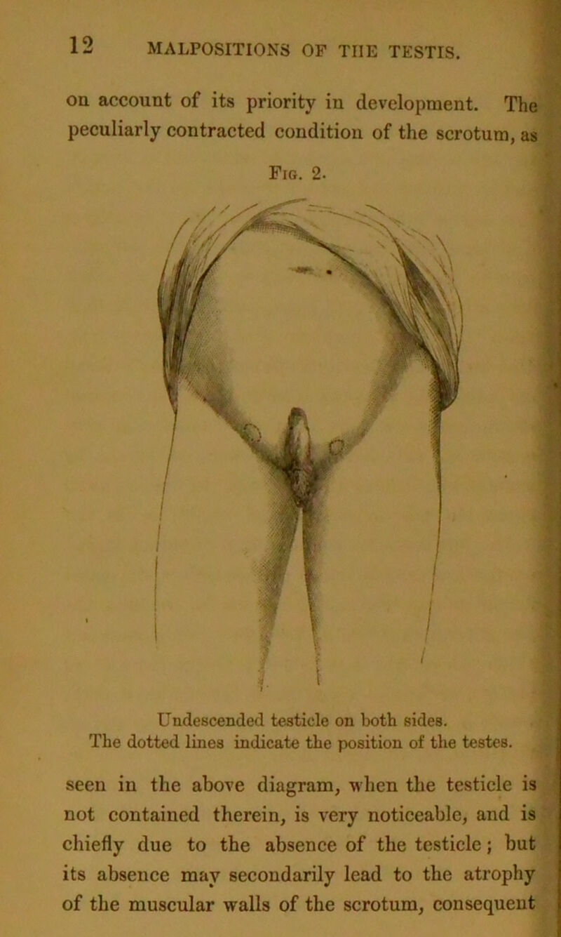 on account of its priority in development. The peculiarly contracted condition of the scrotum, as Fig. 2. Undescended testicle on both sides. The dotted lines indicate the position of the testes. seen in the above diagram, when the testicle is not contained therein, is very noticeable, and is chiefly due to the absence of the testicle; but its absence may secondarily lead to the atrophy of the muscular walls of the scrotum, consequent