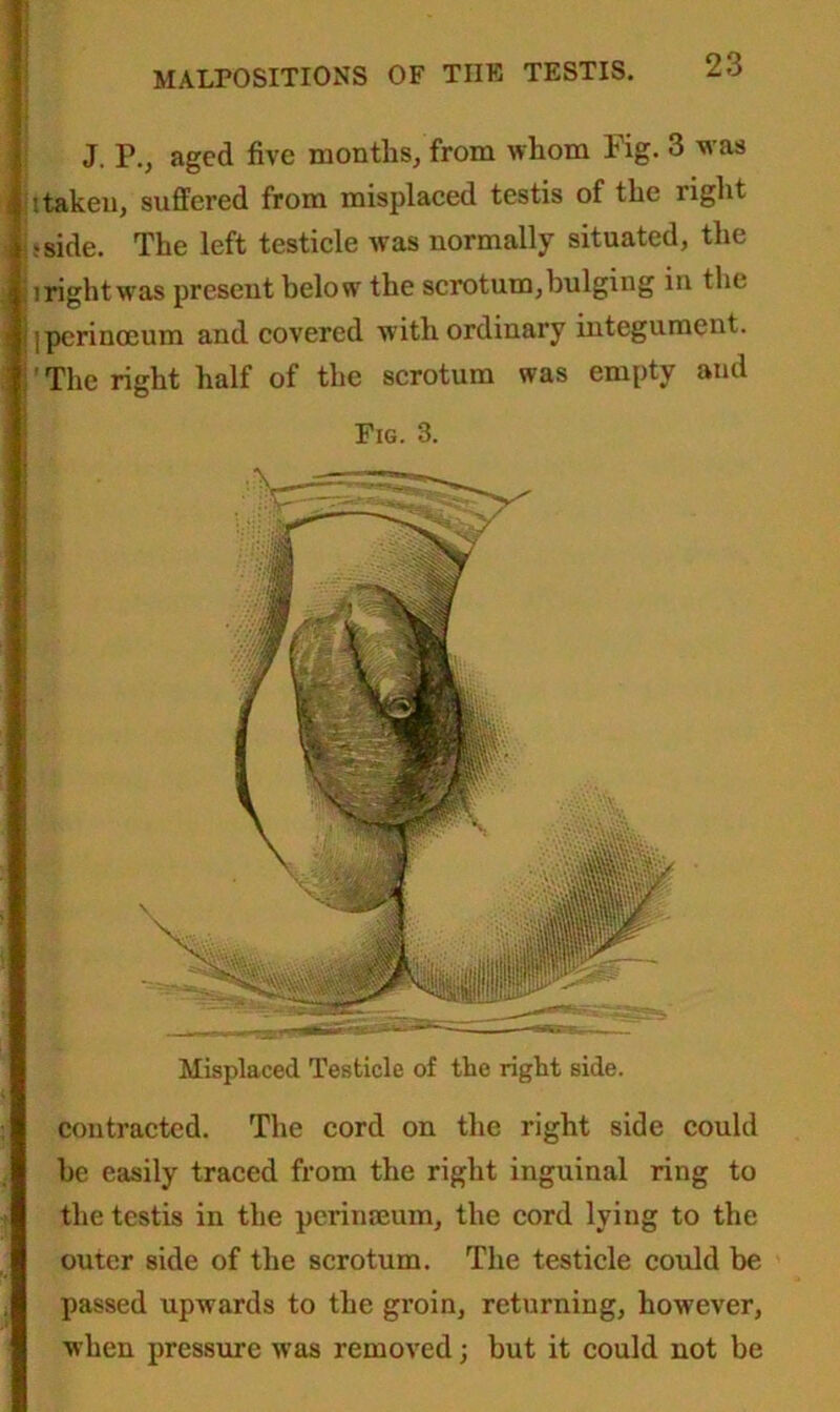 J. P., aged five months, from whom Fig. 3 M as '.taken, suffered from misplaced testis of the right sside. The left testicle was normally situated, the i right was present below the scrotum,bulging in the iperinoeum and covered with ordinary integument. 'The right half of the scrotum was empty and Fig. 3. Misplaced Testicle of the right side. contracted. The cord on the right side could be easily traced from the right inguinal ring to the testis in the perinseum, the cord lying to the outer side of the scrotum. The testicle could be passed upwards to the groin, returning, however, when pressure was removed; but it could not be