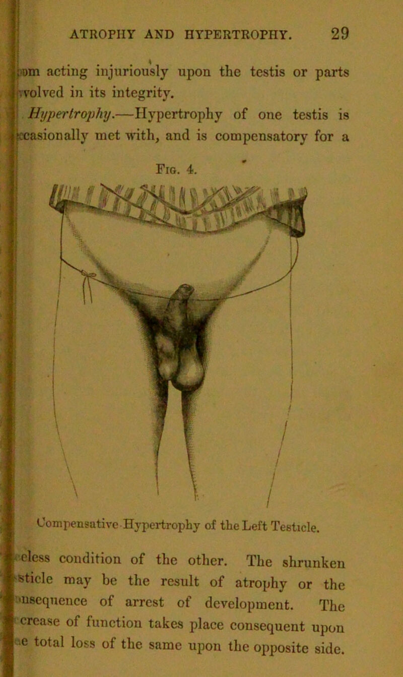 ;>om acting injuriously upon the testis or parts revolved in its integrity. i Hypertrophy.—Hypertrophy of one testis is Occasionally met with, and is compensatory for a Fig. 4. Compensative Hypertrophy of the Left Testicle. eless condition of the other. The shrunker reticle may be the result of atrophy or the | ^sequence of arrest of development. The crease of function takes place consequent upon e total loss of the same upon the opposite side.