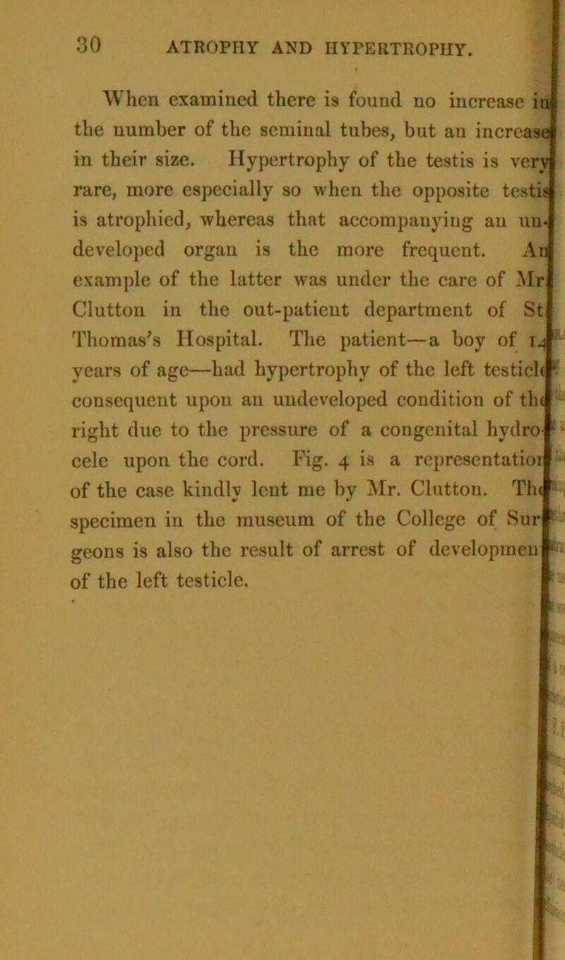 When examined there is found no increase in the number of the seminal tubes, but an increase in their size. Hypertrophy of the testis is very rare, more especially so when the opposite testis is atrophied, whereas that accompanying an un- developed organ is the more frequent. An example of the latter was under the care of Mr Clutton in the out-patient department of St Thomas's Hospital. The patient—a boy of 14 ifl years of age—had hypertrophy of the left testich ‘ consequent upon an undeveloped condition of the right due to the pressure of a congenital hydro- 1 cele upon the cord. Fig. 4 is a representatior of the case kindly lent me by Mr. Clutton. Th< L specimen in the museum of the College of Sur r--: geons is also the result of arrest of developmeu 1 of the left testicle.