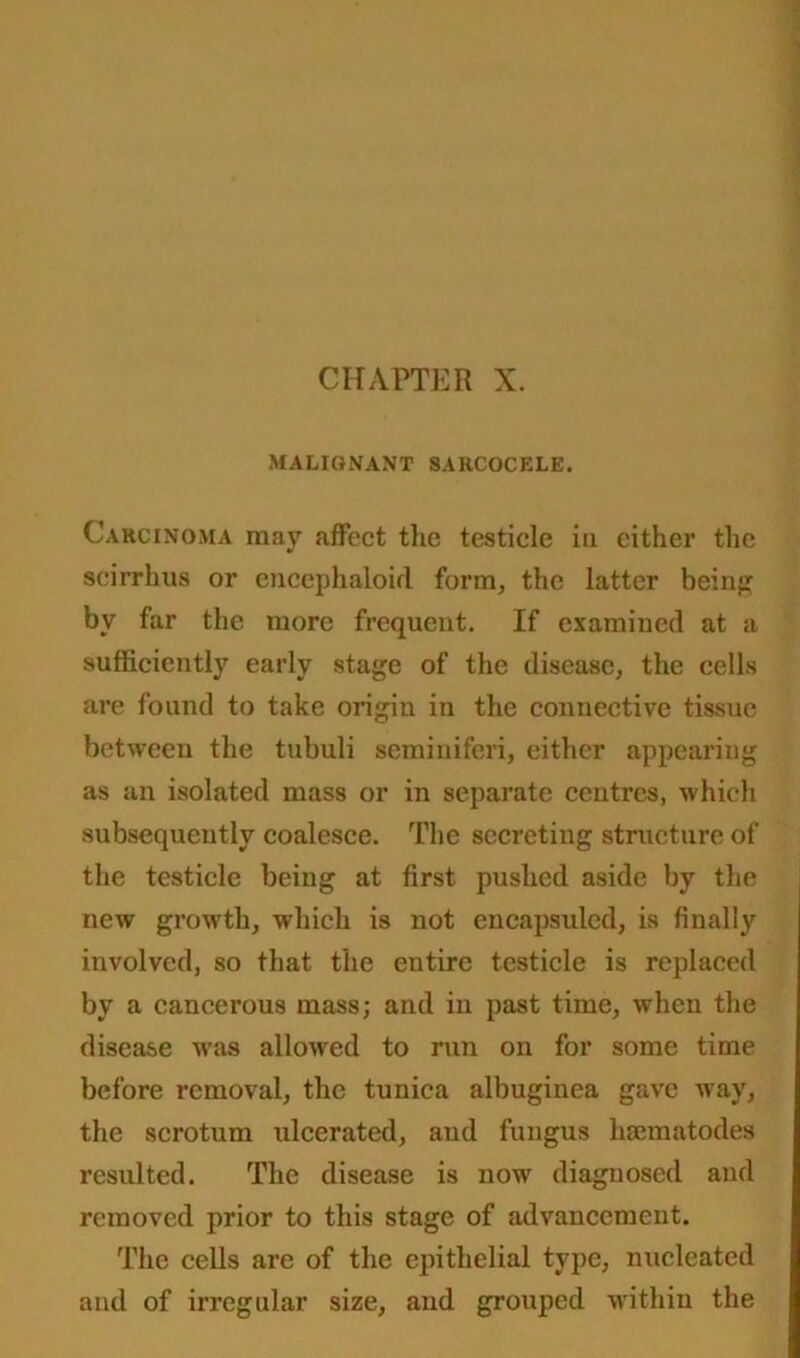 MALIGNANT SARCOCELE. Carcinoma may affect the testicle in cither the scirrhus or encephaloid form, the latter being by far the more frequent. If examined at a sufficiently early stage of the disease, the cells are found to take origin in the connective tissue between the tubuli seminiferi, either appearing as an isolated mass or in separate centres, which subsequently coalesce. The secreting structure of the testicle being at first pushed aside by the new growth, which is not eneapsuled, is finally involved, so that the entire testicle is replaced by a cancerous mass; and in past time, when the disease was allowed to run on for some time before removal, the tunica albuginea gave way, the scrotum ulcerated, and fungus hsematodes resulted. The disease is now diagnosed and removed prior to this stage of advancement. The cells are of the epithelial type, nucleated and of irregular size, and grouped within the