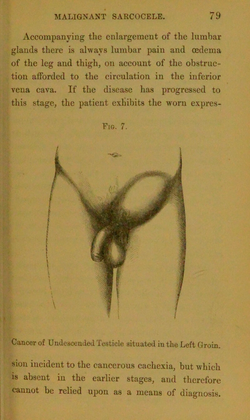 Accompanying the enlargement of the lumbar glands there is always lumbar pain and oedema of the leg and thigh, on account of the obstruc- tion afforded to the circulation in the inferior vena cava. If the disease has progressed to this stage, the patient exhibits the worn expres- Fig. 7. Cancer of Undeseended Testicle situated in the Left Groin. sion incident to the cancerous cachexia, but which is absent in the earlier stages, and therefore cannot be relied upon as a means of diagnosis.