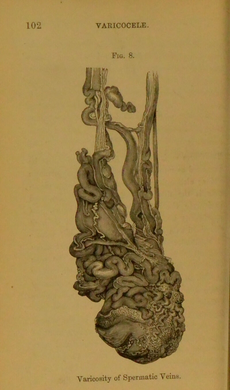 Fig. 8. Varicosity of Spermatic Veins.