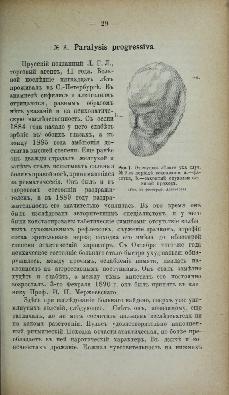 ѵ я. Рагаіузіз рго&геззіѵа. Прусскій подданный Л. Г. .1.. торговый агентъ. 41 года. Боль- ной послѣдніе пятнадцать лѣтъ прожпвалъ въ С.-Петербургѣ. Въ анамнезѣ спфплпсъ п алкоголпзмъ отрицаются. равныыъ образомъ нѣтъ указаній п на психопатиче- скую наслѣдственность. Съ осени 1884 года начало у него слабѣть зрѣніе въ' обопхъ глазахъ. а къ концу 1885 года амбліопія до- стигла высшей степени. Еще ранѣе онъ дважды страдалъ желтухой и .іатѣмъ СТалЪ ПСПЫТЫВатЬ СИЛЬНЫЯ Рнс. х. Отэматома лѣваго уха слтч. ООЛИ ВЪ Правой НОгѢ.ПриНПМаВШІЯСЯ * 2 въ періодѣ всасыванія: а.—фа- X ^ сеткп, Ъ.—закрытый опѵхолью слу- за ревматическія. Онъ оылъ и въ ХОВОй проходъ. ЗДОрОВОМЪ СОСТОЯНІП раЗДраЖП- ^н<-*- « Фотограф. ІлелекоігьК теленъ. а въ 1889 году раздра- жительность его значительно усилилась. Въ это время онъ былъ изслѣдованъ авторптетнымъ спеціалистомъ. и у него были констатированы табетическіе симптомы: отсутствіе колѣн- ныхъ сухожильныхъ рефлексовъ. съуженіе зрачковъ. атрофія соска зрительнаго нерва; походка его имѣла до нѣкоторой степени атактпческій характеръ. Съ Октября того-же года психическое состояніе больнаго стало быстро ухудшаться: обна- ружилось, между прочпмъ. ослабленіе памяти, явилась на- клонность къ аггресспвнымъ поступкамъ. Онъ сталъ замѣтно худѣтъ и слабѣть, а между тѣмъ аппетптъ его постоянно возросталъ. 3-го Февраля 1890 г. онъ былъ принять въ кли- нику Проф. И. П. Мержеевскаго. Здѣсь при пзслѣдованіп больнаго найдено, сверхъ уже упо- мянутыхъ явленіп. слѣдующее.—Свѣтъ онъ, поводимому, еще различалъ, но не могъ сосчитать пальцевъ пзслѣдователя ни на какомъ разстояніп. Пульсъ удовлетворительно наполнен- ный, рптмпческій. Походка отчасти атактпческая. но болѣе пре- обладаете» въ ней парэтпческій характеръ. Въ языкѣ и ко- нечностяхъ дрожаніе. Кожная чувствительность на нпжнпхъ