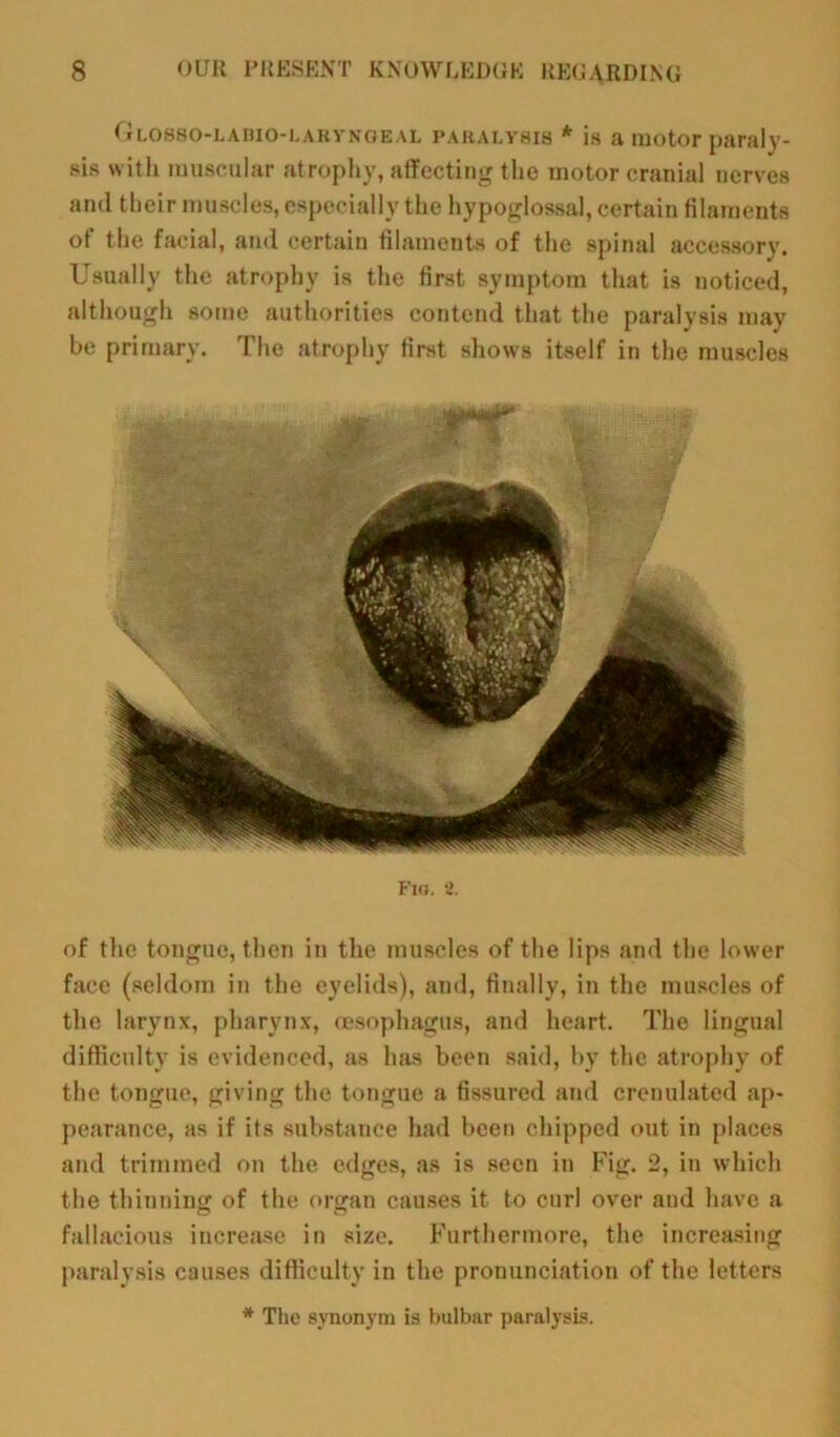 Glosso-lahio-laryngeal paralysis * is a motor paraly- sis with muscular atrophy, affecting the motor cranial nerves and their muscles, especially the hypoglossal, certain filaments of the facial, and certain filaments of the spinal accessory. Usually the atrophy is the first symptom that is noticed, although some authorities contend that the paralysis may be primary. The atrophy first shows itself in the muscles Fig. 2. of the tongue, then in the muscles of the lips and the lower face (seldom in the eyelids), and, finally, in the muscles of the larynx, pharynx, oesophagus, and heart. The lingual difficulty is evidenced, as has been said, by the atrophy of the tongue, giving the tongue a fissured and crenulated ap- pearance, as if its substance had been chipped out in places and trimmed on the edges, as is seen in Fig. 2, in which the thinning of the organ causes it to curl over and have a fallacious increase in size. Furthermore, the increasing paralysis causes difficulty in the pronunciation of the letters * The synonym is bulbar paralysis.