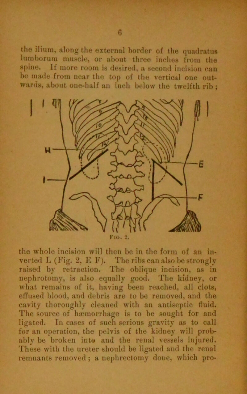 the ilium, along the external border of the quadratus lain borani muscle, or about three inches from the spine. If more room is desired, a second incision can be made from near the top of the vertical one out- wards, about one-half an inch below the twelfth rib ; the whole incision will then be in the form of an in- verted L (Fig. 2, E F). The ribs can also be strongly raised by retraction. The oblique incision, as in nephrotomy, is also equally good. The kidney, or what remains of it, having been reached, all clots, effused blood, and debris are to be removed, and the cavity thoroughly cleaned with an antiseptic fluid. The source of haemorrhage is to be sought for and ligated. In cases of such serious gravity as to call for an operation, the pelvis of the kidney will prob- ably be broken into and the renal vessels injured. These with the ureter should be ligated and the renal remnants removed ; a nephrectomy done, which pro-