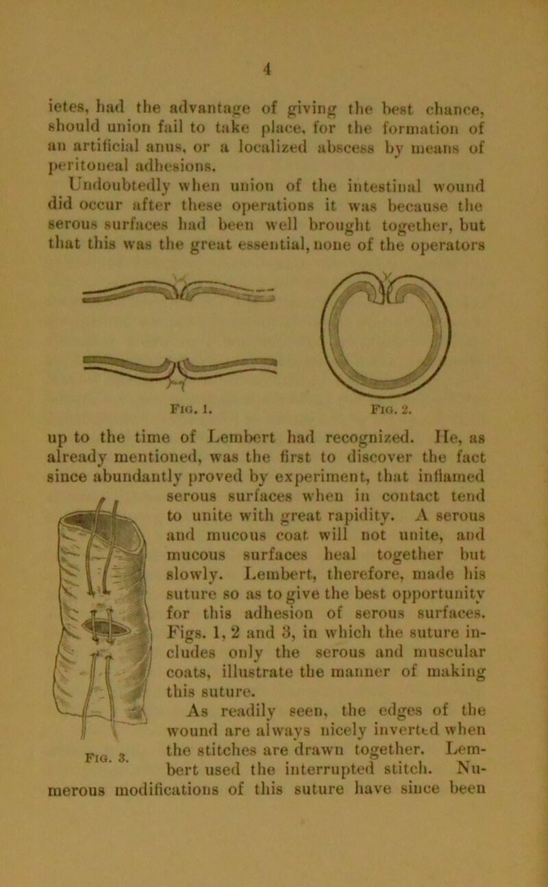 ietes, had the advantage of giving the best chance, should union fail to take place, for the formation of an artificial anus, or a localized abscess by means of peritoneal adhesions. Undoubtedly when union of the intestinal wound did occur after these operations it was because the serous surfaces had been well brought together, but that this was the great essential, none of the operators Fio. i. Fig. 2. up to the time of Lemhort had recognized. He, as already mentioned, was the first to discover the fact since abundantly proved by experiment, that inflamed serous surfaces when in contact tend to unite with great rapidity. A serous and mucous coat will not unite, and mucous surfaces heal together but slowly. Lembert, therefore, made his suture so as to give the best opportunity for this adhesion of serous surfaces. Figs. 1, 2 and 3, in which the suture in- cludes only the serous and muscular coats, illustrate the manner of making this suture. As readily seen, the edges of the wound are always nicely inverted when the stitches are drawn together. Lem- bert used the interrupted stitch. Nu- modifications of this suture have since been Fig. 3. merous