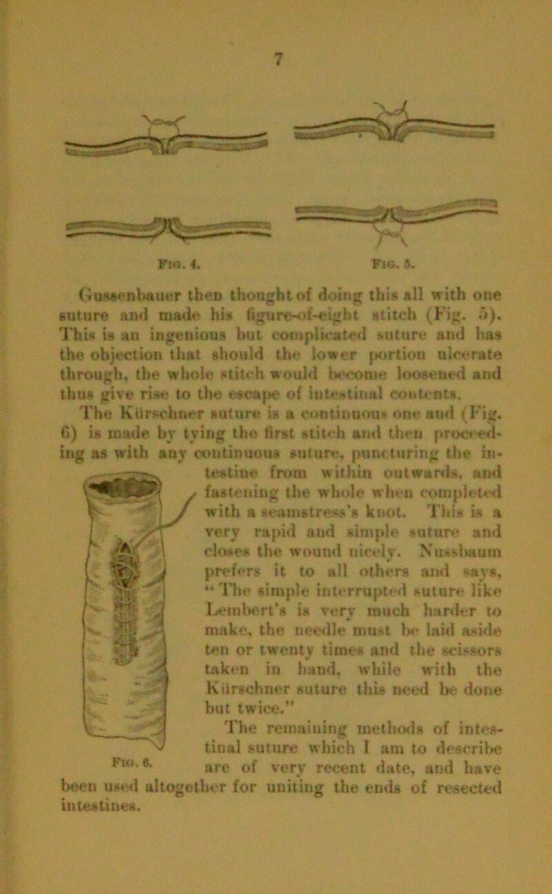 Fit'.. 4. Fki. 5. Guuenbaiwr then thought of doing this *11 with one suture and made his figure-of-eight stitch (Fig. 5). This is an ingenious but complicated suture and has the objection that should the lower portion ulcerate through, the whole stitch would become loosened and thus give rise to the escape of intestinal contents. The Kursohner suture is a continuous one anil (Fig. fi) is made by tying the first stitch and then proceed- ing as with auy continuous suture, puncturing the in- testine from within outwards, and fastening the whole when completed with a seamstress’s knot. This is a very rapid and simple suture and closes the wound nicely. Nussbaum prefers it to all others and says, “The simple interrupted suture like Lembert's is very much harder to make, the needle must 1>e laid aside ten or twenty times and the scissors taken in hand, while with the Kiirschner suture this need be done but twice. The remaining methods of intes- tinal suture which I am to describe are of very recent date, and have been used altogether for uniting the euds of resected intestines.