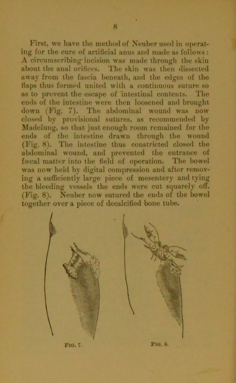 First, we have the method of Neuber used in operat- ing for the cure of artificial anus and made as follows : A circumscribing'incision was made through the skin about the anal orifices. The skin was then dissected away from the fascia beneath, and the edges of the flaps thus formed united with a continuous suture so as to prevent the escape of intestinal contents. The ends of the intestine were then loosened and brought down (Fig. 7). The abdominal wound was now closed by provisional sutures, as recommended by Madelung, so that just enough room remained for the ends of the intestine drawn through the wound (Fig. 8). The intestine thus constricted closed the abdominal wound, and prevented the entrance of f«:cal matter into the field of operation. The bowel was now held by digital compression and after remov- ing a sufficiently large piece of mesentery and tying the bleeding vessels the ends were cut squarely off. (Fig. 8). Neuber now sutured the ends of the bowel together over a piece of decalcified bone tube.