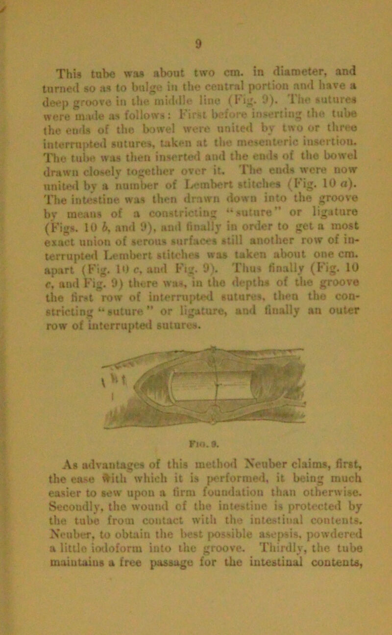 This tube was about two cm. in diameter, and turned so as to bulge in the central portion and have a deep groove in the middle line (Fig. 9)« I he sutures were made as follows: First before inserting the tube the ends of the bowel were united by two or three interrupted sutures, taken at the mesenteric insertion. The tube was then inserted and the ends of tho bowel drawn closely together over it. The ends were now united bv a number of L»*mbert stitches (Fig. 10 a). The intestine was then drawn down into the groove by means of a constricting “suture” or ligature (Figs. 10 b. and 9), and finally in order to get a most exact union of serous surfaces still another row of in- terrupted Lembert stitches was taken about one cm. apart (Fig. 10 c, and Fig. 9). Thus finally (Fig. 10 c, and Fig. 9) there was in the depth* of the groove the first row of interrupted sutures, then tho con- stricting “ suture ” or ligature, and finally an outer row' of interrupted sutures. FlO. 9. As advantages of this method Neuber claims, first, the ease ftitli which it is performed, it being much easier to sew upon a firm foundation than otherwise. Secondly, the wound of the intestine is protected by the tube from contact with the intestinal contents. Nouber, to obtain the best possible asepsis, powdered a little iodoform into the groove. Thirdly, the tube maintains a free passage for the intestinal contents,