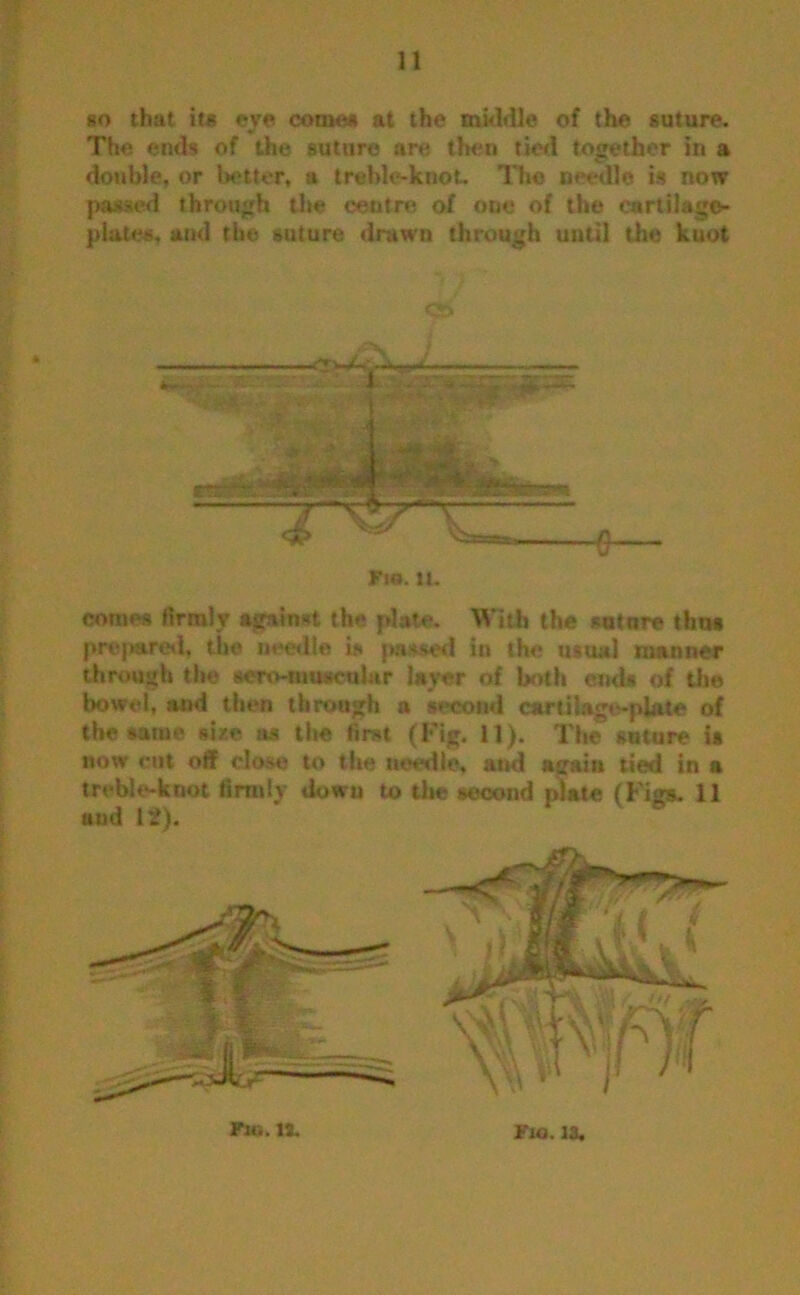 so that its eve coma* at the middle of the suture. The ends of the suture are then tied together in a double, or better, a treble-knot- The needle is now passed through the centre of one of the cartilage- plates, and the suture drawn through until the kuot ■*«-.-*** ■» — -1 -tJMgm Wrsr*.. V - 1 Fio. U. comes firmly against the plate. With the suture tlrn* prepared, the needle is passed in the usual manner through the aero-muscular layer of both ends of the bowel, and then through a second cartilage-plate of the same size as the first (Fig. 11). The suture i* now cut off close to the needle, and again tied in a treble-knot firmly dowu to the second plate (Figs. 11 uud 12).