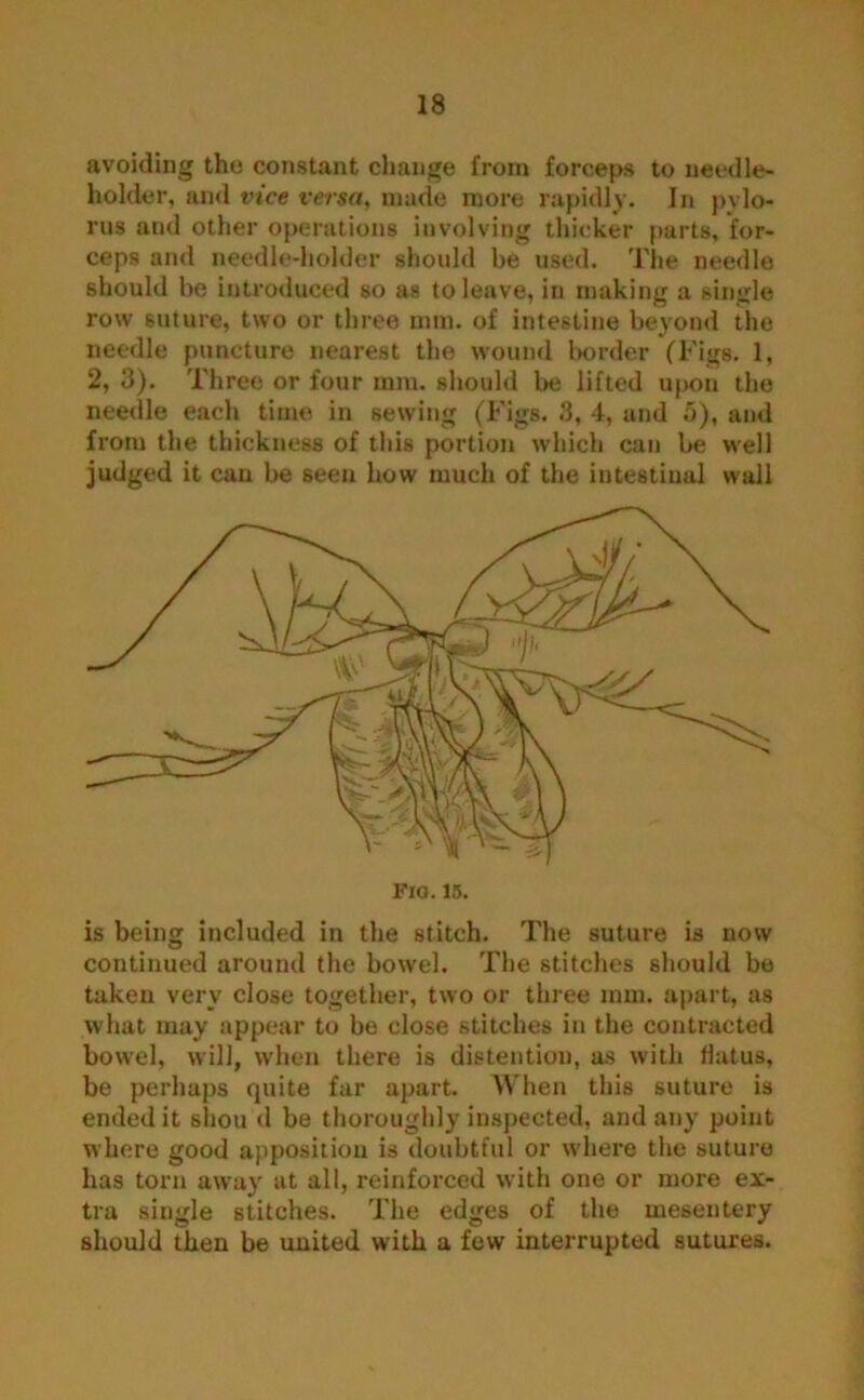 avoiding the constant change from forceps to needle- holder, and vice versa, made more rapidly. In pylo- rus and other operations involving thicker parts, for- ceps and needle-holder should be used. The needle should be introduced so as to leave, in making a single row suture, two or three mm. of intestine beyond the needle puncture nearest the wound border (Figs. 1, 2, 3). Three or four mm. should l>e lifted upon the needle each time in sewing (Figs. 3, 4, and 5), and from the thickness of this portion which can be well judged it can be seen how much of the intestinal wall is being included in the stitch. The suture is now continued around the bowel. The stitches should be taken very close together, two or three mm. apart, as what may appear to be close stitches in the contracted bowel, will, when there is distention, as with flatus, be perhaps quite far apart. When this suture is ended it shou d be thoroughly inspected, and any point where good apposition is doubtful or where the suture has torn away at all, reinforced with one or more ex- tra single stitches. The edges of the mesentery should then be united with a few interrupted sutures.
