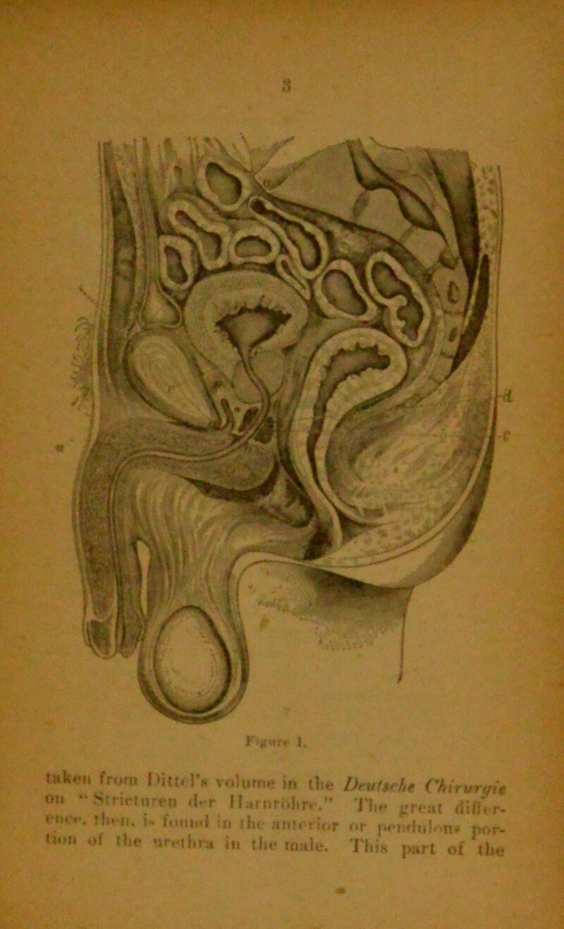 f *tfwr«r I. tuken from I )iti« 1*» volume in the Dmltche Chirurqit on “ Strietaren <hr H^rnritStre.** The great differ- enre. then, i- fomel in the ahl. ru,r <,r [venfiuhm* por- l“' of the urethra in the male. This part of the