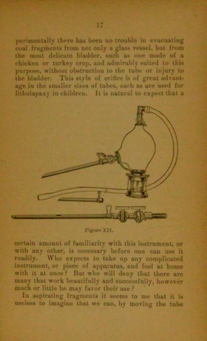 jwjrimentally there ha» Wen no trouble in evacuatiug coal fragments from not only a glass vessel, but front the most delicate bladder, such as one made of a chicken or turkey crop, and admirably suited to this purpose, without obstruction to the tula1 or injury to the bladder. This style of orifice is of great advant- age in the smaller sires of tubes, such as are used for litholapaxy in children. It is natural to expect that a Figure \Il. certain amount of familiarity with this instrument, or with any other, is necessary before oue can use it readily. Who expects to take up any complicated instrument, or piece of apparatus, and feel at home with u at onoe? But who will deny that there are many that work beautifully and successfully, however much or little he may favor their use? In aspirating fragments it seems to me that it is useless to imagine that we can, by moving the tube