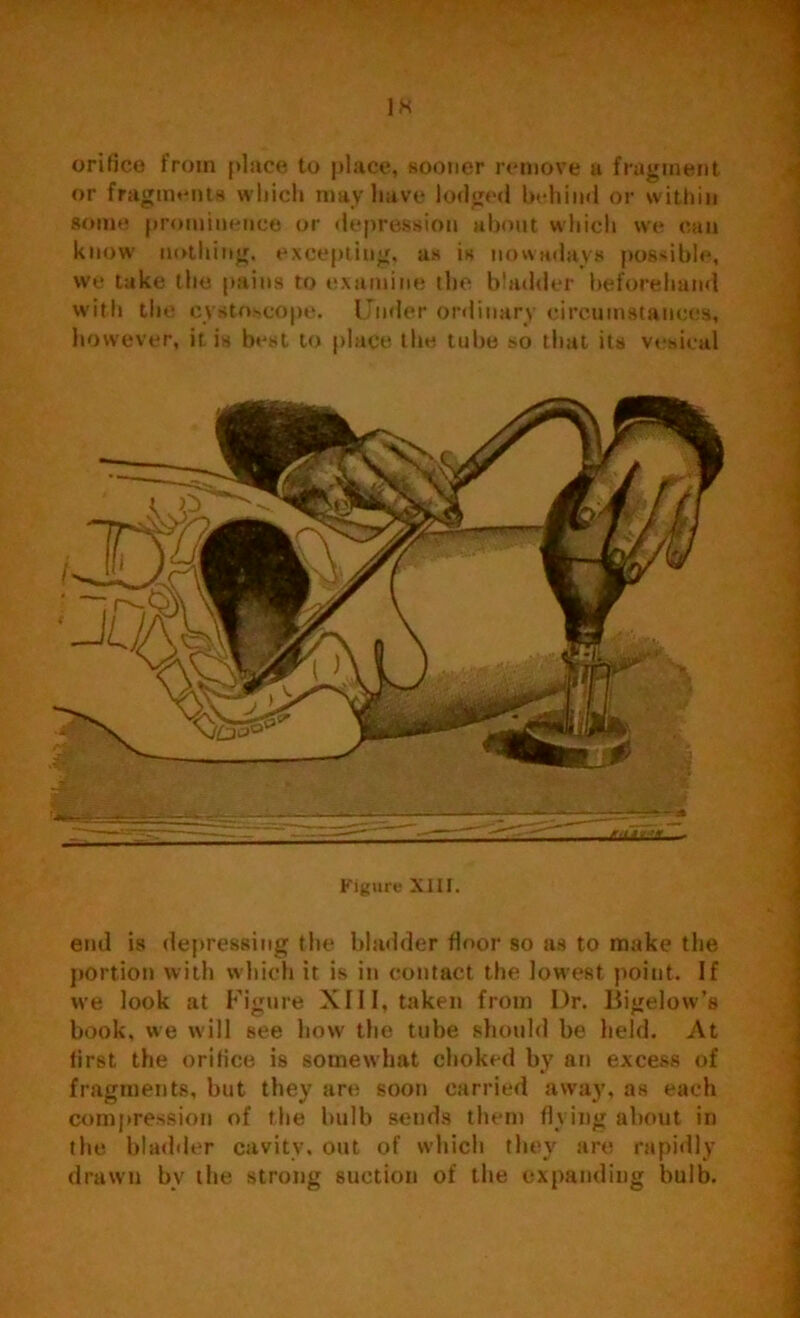 orifice from place to place, sootier remove a fragment or fragments which may have lodged behind or within some prominence or depression about which we can know' nothing, excepting, as is nowadays possible, we take the pains to examine the bladder beforehand with the cystnscope. Under ordinary circumstances, however, it is best to place the tube so that its vesical Figure XIII. end is depressing the bladder floor so us to make the portion with which it is in contact the lowest point. If we look at Figure XIII, taken from Dr. Bigelow’s book, we will see how the tube should be held. At first the orifice is somewhat choked by an excess of fragments, but they are soon carried away, as each compression of the bulb sends them flying about in the bladder cavity, out of which they are rapidly drawn bv the strong suction of the expanding bulb.