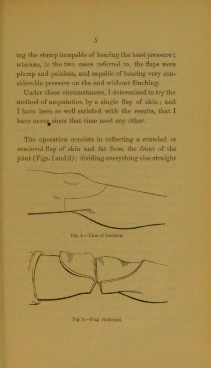 ing tlio stamp incapable of bearing the least pressure ; whereas, in the two cases referred to, the flaps were plump and painless, and capable of bearing very con- siderable pressure on the end without flinching. Under these circumstances, l determined to try the method of amputation by a single flap of skin ; and I have been so well satisfied with the results, that I have neve^since that time used any other. The operation consists in reflecting a rounded or semiovnl flnp of skin and fat from the front of the joint ( Figs. 1 and 2); dividing everything else straight Kljf. 2.—Fi*p Reflected.