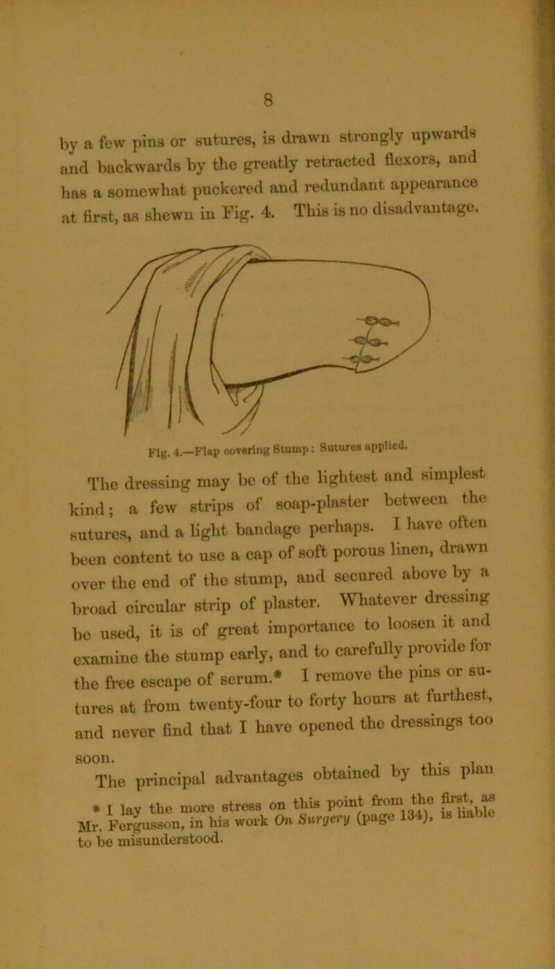 by a few pins or sutures, is drawn strongly upwards and backwards by the greatly retracted flexors, and has a somewhat puckered and redundant appearance at first, as shewn in Fig. 4. This is no disadvantage. Fig. 4.—Flap covering Btump: Sutures applied. The dressing may be of the lightest and simplest kind; a few strips of soap-plaster between the sutures, and a light bandage perhaps. I have often been content to use a cap of soft porous linen, drawn over the end of the stump, and secured above by a broad circular strip of plaster. Whatever dressing be used, it is of great importance to loosen it and examine the stump early, and to carefully provide tor the free escape of serum* I remove the pins or su- tures at from twenty-four to forty hours at furthest, and never find that I have opened the dressings too soon. , The principal advantages obtained by this p an * I lay the more stress on this point from- the Brst, « Mr. Pergusson, in his work On Surgery (page 134), is ha to be misunderstood.