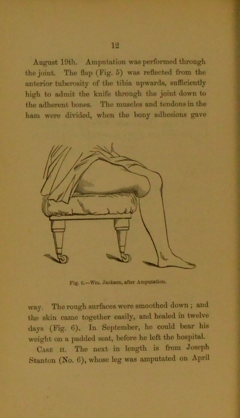 August 19th. Amputation was performed through the joint. The flap (Fig. 5) was reflected from the anterior tuberosity of the tibia upwards, sufficiently high to admit the knife through the joint down to the adherent bones. The muscles and tendons in the ham were divided, when the bony adhesions gave Fig. C.—Wra. Jackson, after Amputatiou. way. The rough surfaces were smoothed down ; and the skin came together easily, and healed in twelve days (Fig. 6). In September, he could bear his weight on a padded seat, before he left the hospital. Case ii. The next in length is from Joseph Stanton (No. G), whose leg was amputated on April