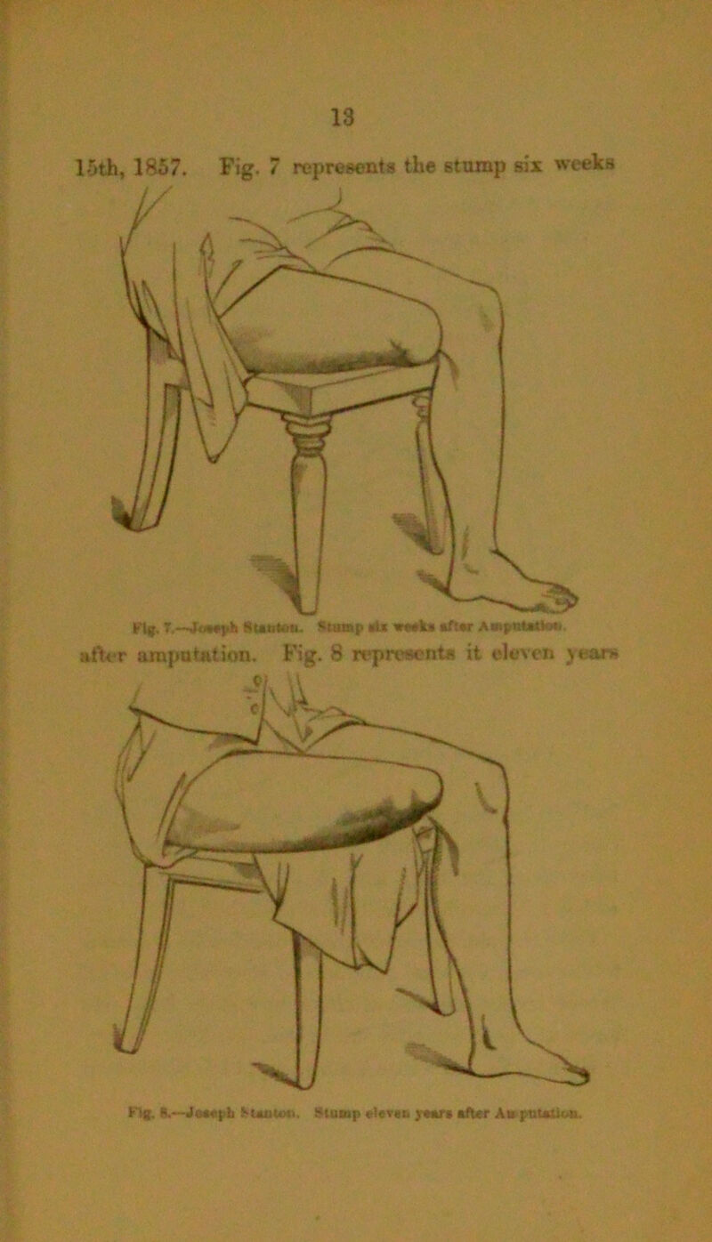 15th, 1857. Fig. 7 represents the stump six weeks after amputation. Fig. 8 represent* it eleven J ear.' Fig, S.~Jo*«pI> FUiiton, Stump (“level. jeut »fUr At puuiion.