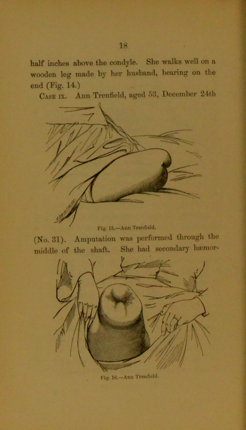 half inches above the condyle. She walks well on a wooden leg made by her husband, bearing on the end (Fig. 14.) Case ix. Ann Trenfield, aged 53, December 24th (No. 31). Amputation was performed through the middle of the shaft. She had secondary hirmor- Fig. 16.—Ann Trenfield.