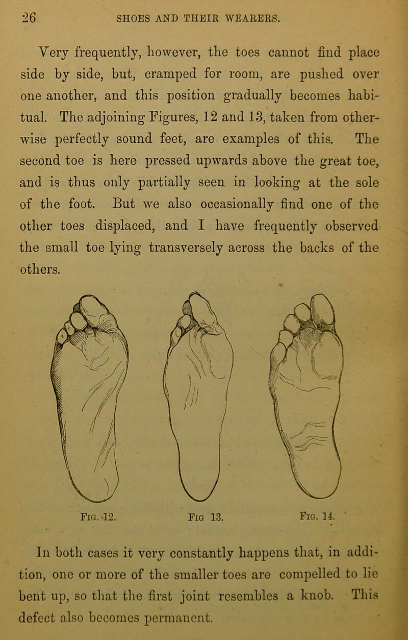 Very frequently, however, the toes cannot find place side by side, but, cramped for room, are pushed over one another, and this position gradually becomes habi- \ tual. The adjoining Figures, 12 and 13, taken from other- wise perfectly sound feet, are examples of this. The second toe is here pressed upwards above the great toe, and is thus only partially seen in looking at the sole of the foot. But we also occasionally find one of the other toes displaced, and I have frequently observed the small toe lying transversely across the backs of the others. In both cases it very constantly happens that, in addi- tion, one or more of the smaller toes are compelled to lie bent up, so that the first joint resembles a knob. This defect also becomes permanent.