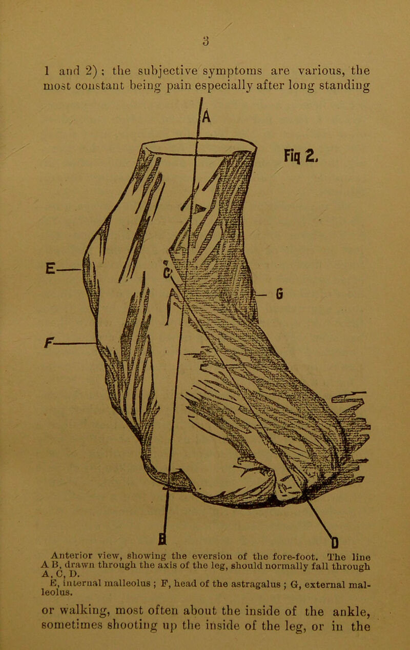 1 and 2) ; tlie subjective symptoms are various, the most constant being pain especially after long standing Anterior view, showing the eversion of the fore-foot. The line A B. drawn through the axis of the leg, should normally fall through A, C, D. E, iniernal malleolus ; F, head of the astragalus ; G, external mal- leolus. or walking, most often about the inside of the ankle, sometimes shooting up the inside of the leg, or in the