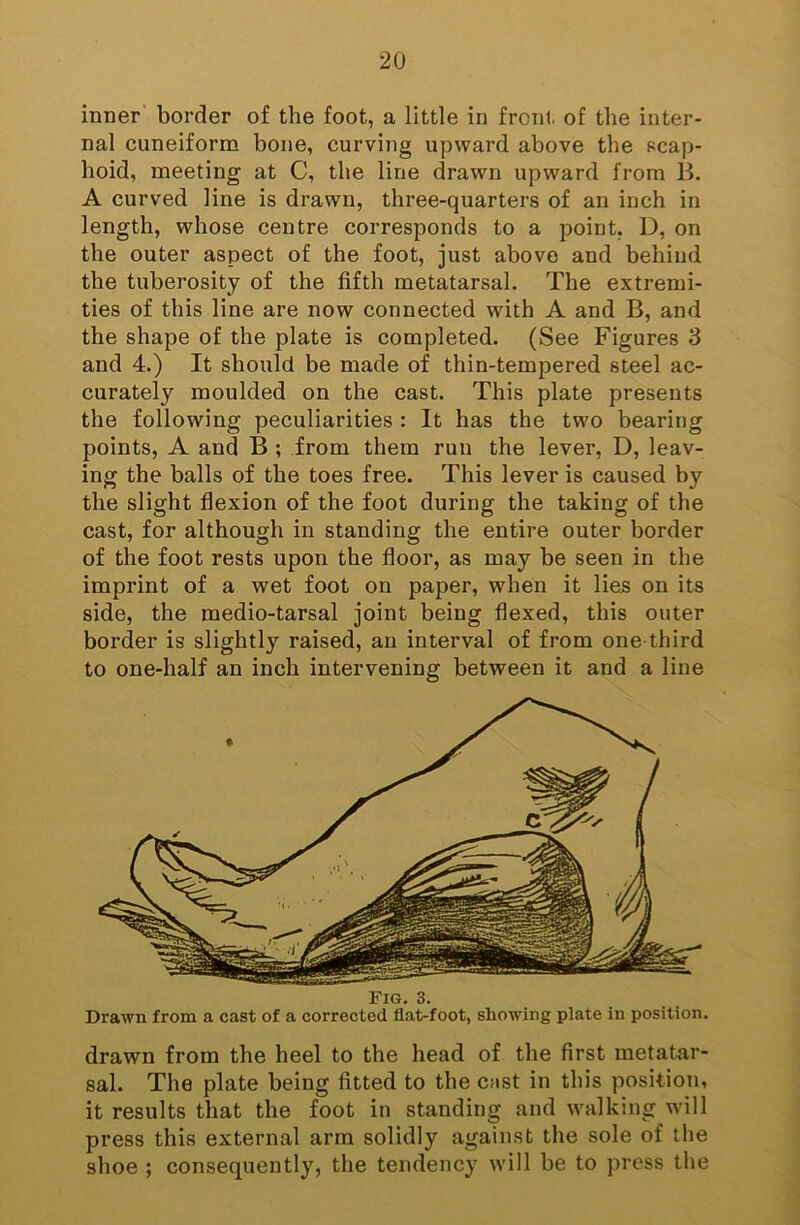 inner' border of the foot, a little in front, of the inter- nal cuneiform bone, curving upward above the scap- hoid, meeting at C, the line drawn upward from B. A curved line is drawn, three-quarters of an inch in length, whose centre corresponds to a point, D, on the outer aspect of the foot, just above and behind the tuberosity of the fifth metatarsal. The extremi- ties of this line are now connected with A and B, and the shape of the plate is completed. (See Figures 3 and 4.) It should be made of thin-tempered steel ac- curately moulded on the cast. This plate presents the following peculiarities : It has the two bearing points, A and B ; from them run the lever, D, leav- ing the balls of the toes free. This lever is caused by the slight flexion of the foot during the taking of the cast, for although in standing the entire outer border of the foot rests upon the floor, as may be seen in the imprint of a wet foot on paper, when it lies on its side, the medio-tarsal joint being flexed, this outer border is slightly raised, an interval of from one-third to one-half an inch intervening between it and a line Fig. 3. Drawn from a cast of a corrected flat-foot, sliowing plate in position. drawn from the heel to the head of the first metatar- sal. The plate being fitted to the cast in this position, it results that the foot in standing and walking will press this external arm solidly against the sole of the shoe ; consequently, the tendency will be to press the