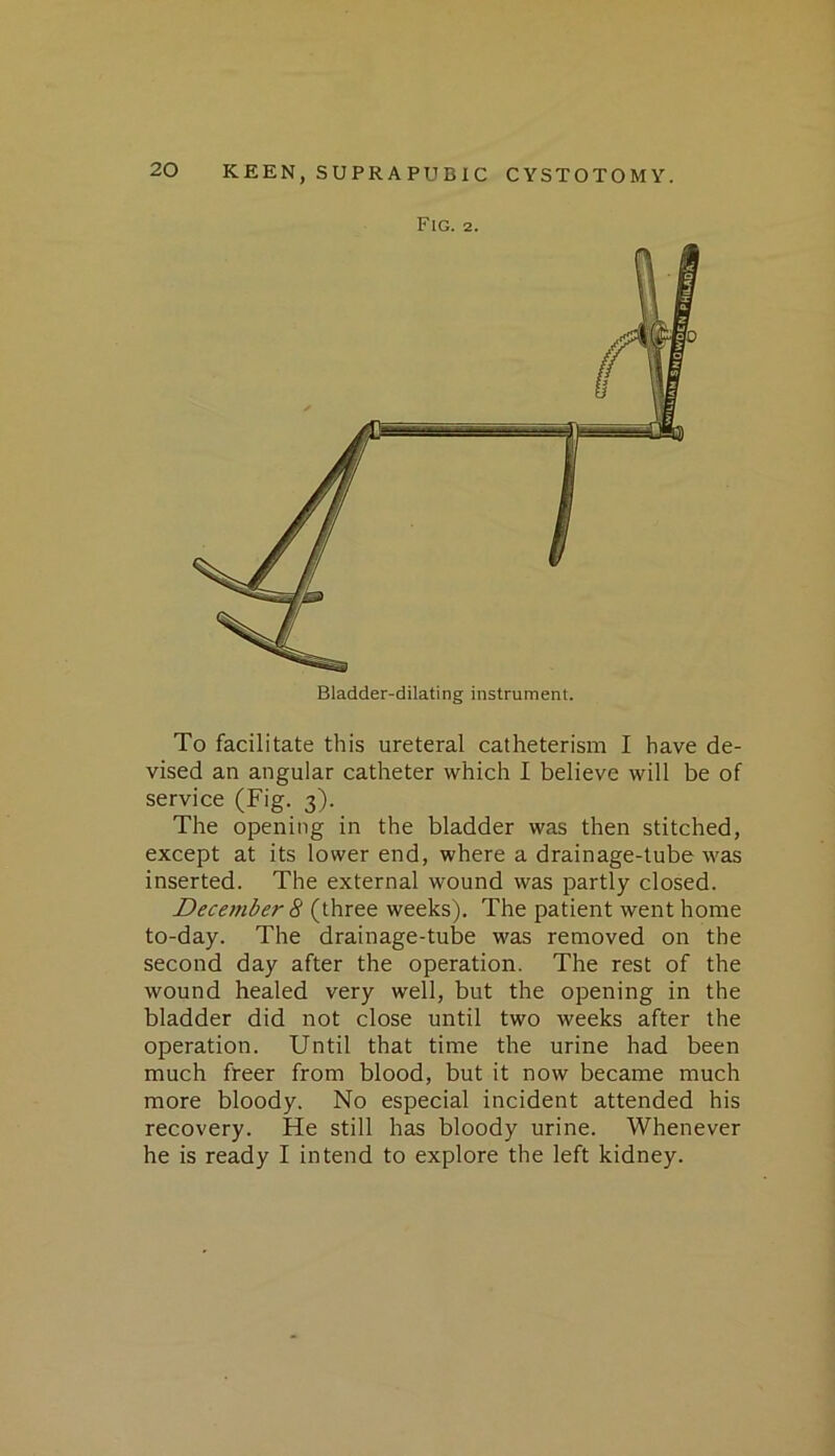 Fig. 2. Bladder-dilating instrument. To facilitate this ureteral catheterism I have de- vised an angular catheter which I believe will be of service (Fig. 3). The opening in the bladder was then stitched, except at its lower end, where a drainage-tube was inserted. The external wound was partly closed. December 8 (three weeks). The patient went home to-day. The drainage-tube was removed on the second day after the operation. The rest of the wound healed very well, but the opening in the bladder did not close until two weeks after the operation. Until that time the urine had been much freer from blood, but it now became much more bloody. No especial incident attended his recovery. He still has bloody urine. Whenever he is ready I intend to explore the left kidney.