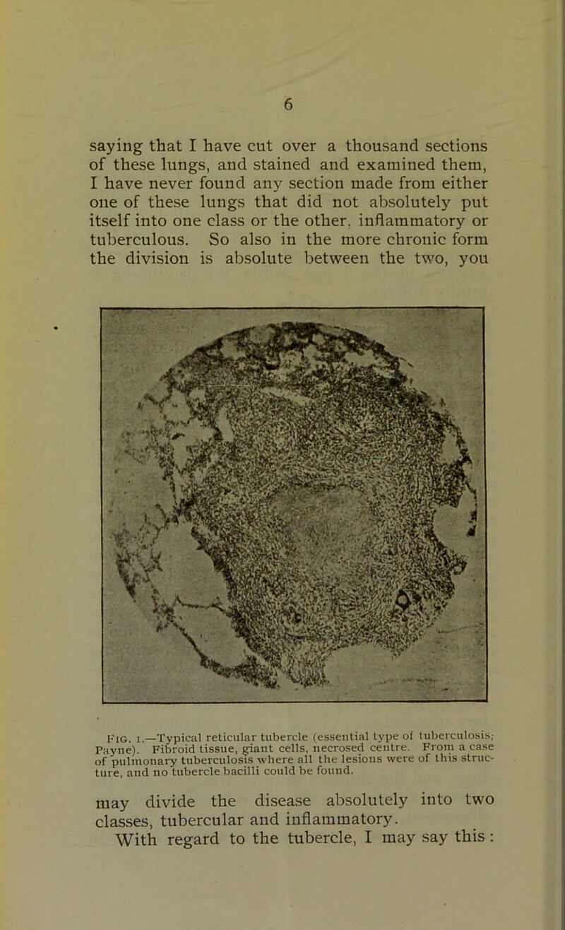 saying that I have cut over a thousand sections of these lungs, and stained and examined them, I have never found any section made from either one of these lungs that did not absolutely put itself into one class or the other, inflammatory or tuberculous. So also in the more chronic form the division is absolute between the two, you Fig. i.—Typical reticular tubercle (essential type of tuberculosis,- Payne). Fibroid tissue, ^iant cells, necrosed centre. From a case of pulmonary tuberculosis where all the lesions were of this struc- ture, and no tubercle bacilli could be found. may divide the disease absolutely into two classes, tubercular and inflammatory. With regard to the tubercle, I may say this :