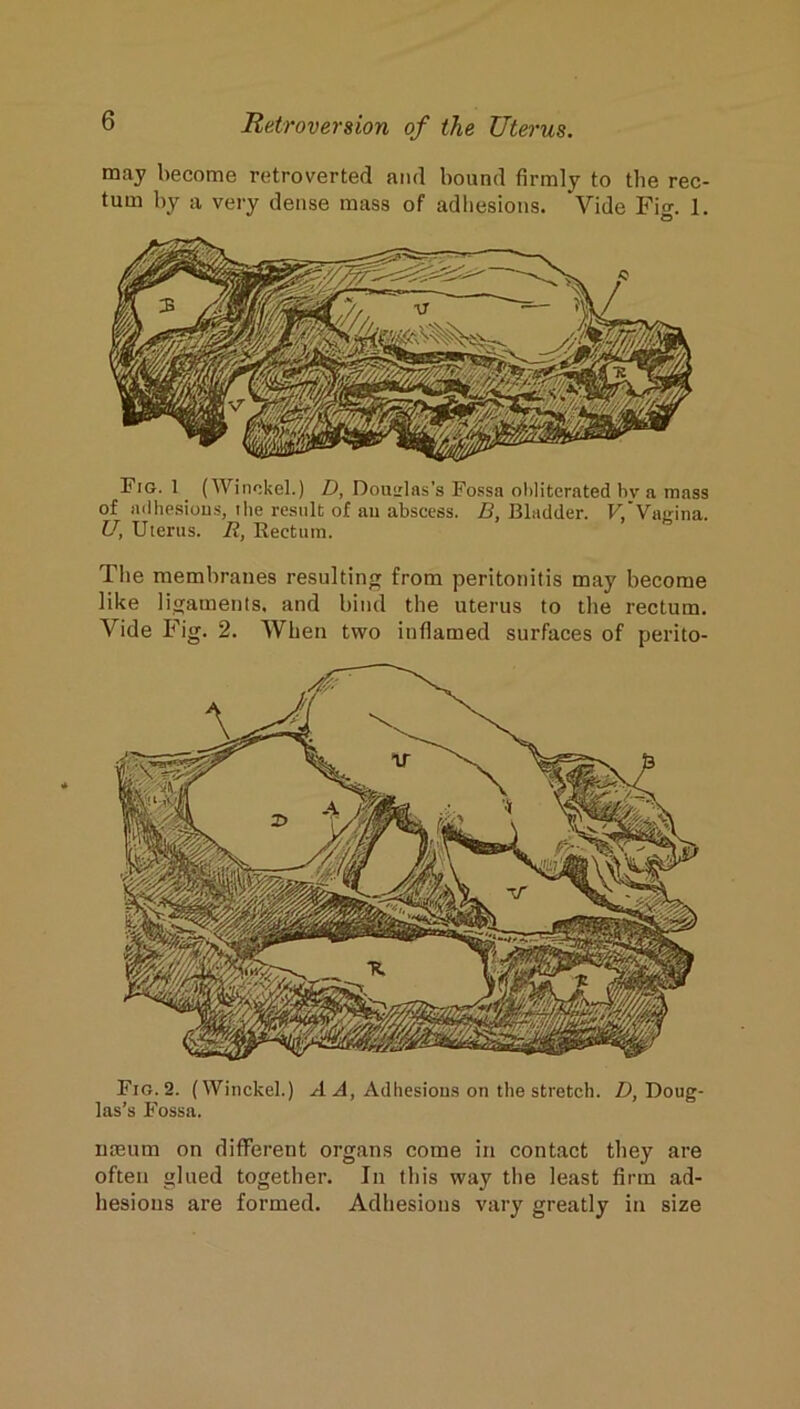 may become retroverted and bound firmly to the rec- tum by a very dense mass of adhesions. Vide Fig. 1. Fig. 1 ^ (Wirif.kel.) D, Douirlas’s Fossa oliliterated bv a mass of adhesious, tlie result of au abscess. .C, Bladder. F.’Vairina. U, Uterus. R, Rectum. Tlie membranes resulting from peritonitis may become like ligaments, and bind the uterus to the rectum. Vide Fig. 2. When two inflamed surfaces of perito- Fio.2. (Winckel.) .d. Adhesions on the stretch. Z), Doug- las’s Fossa. uteum on different organs come in contact they are often glued together. In this way the least firm ad- hesions are formed. Adhesions vary greatly in size