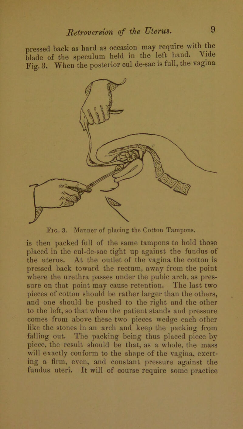 pressed back as hard as occasion may require with the blade of the speculum held in the left hand. Vide Fig. 3. When the posterior cul de-sac is full, the vagina is then packed full of the same tampons to hold those placed in the cul-de-sac tight up against the fundus of the uterus. At the outlet of the vagina the cotton is pressed back toward the rectum, away from the point where the urethra passes under the pubic arch, as pres- sure on that point may cause retention. The last two pieces of cotton should be rather larger than the others, and one should be pushed to the right and the other to the left, so that when the patient stands and pressure comes from above these two pieces wedge each other like the stones in an arch and keep the packing from falling out. The packing being thus placed piece by piece, the result should he that, as a whole, tlie mass will exactly conform to the shape of the vagina, exert- ing a firm, even, and constant pressure against the fundus uteri. It will of course require some practice