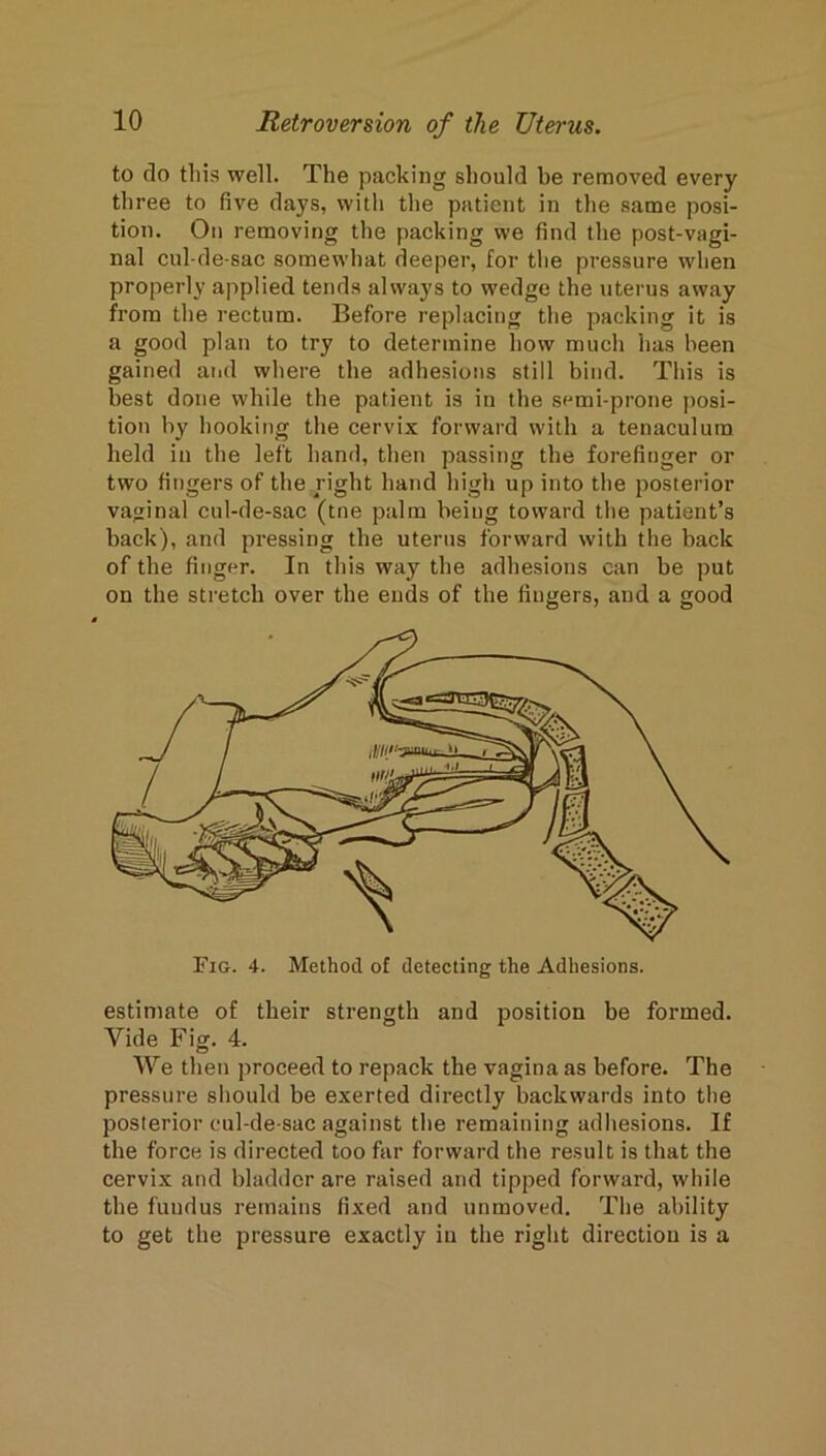 to do this well. The packing should be removed every three to five days, with the patient in the same posi- tion. On removing the packing we find the post-vagi- nal cul-de-sac somewhat deeper, for the pressure when properly applied tends always to wedge the uterus away from the rectum. Before replacing the packing it is a good plan to try to determine how much has been gained aiid where the adhesions still bind. This is best done while the patient is in the semi-prone jiosi- tion by hooking the cervix forward with a tenaculum held in the left hand, then passing the forefinger or two fingers of the right hand high up into the posterior vaginal cul-de-sac (tne palm being toward the patient’s back), and pressing the uterus forward with the back of the finger. In this way the adhesions can be put on the stretch over the ends of the fingers, and a good estimate of their strength and position be formed. Vide Fig. 4. We then proceed to repack the vagina as before. The pressure should be exerted directly backwards into the posterior cul-de-sac against the remaining adhesions. If the force is directed too far forward the result is that the cervix and bladder are raised and tipped forward, while the fuudus remains fixed and unmoved. The ability to get the pressure exactly in the right direction is a