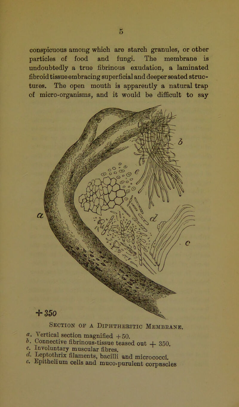 conspicuous among which are starch granules, or other particles of food and fungi. The membrane is undoubtedly a true fibrinous exudation, a laminated fibroid tissue embracing superficial and deeper seated struc- tures. The open mouth is apparently a natural trap of micro-organisms, and it would be difficult to say Section of a Diphthehitic Membbane. a. Vertical section magnified +50. b. Connective fibrinous-tissne teased out 4- 350. Involuntary muscular fibres. Leptothrix filaments, bacilli and micrococci. e. Epithelium cells and muco-purulent corpuscles