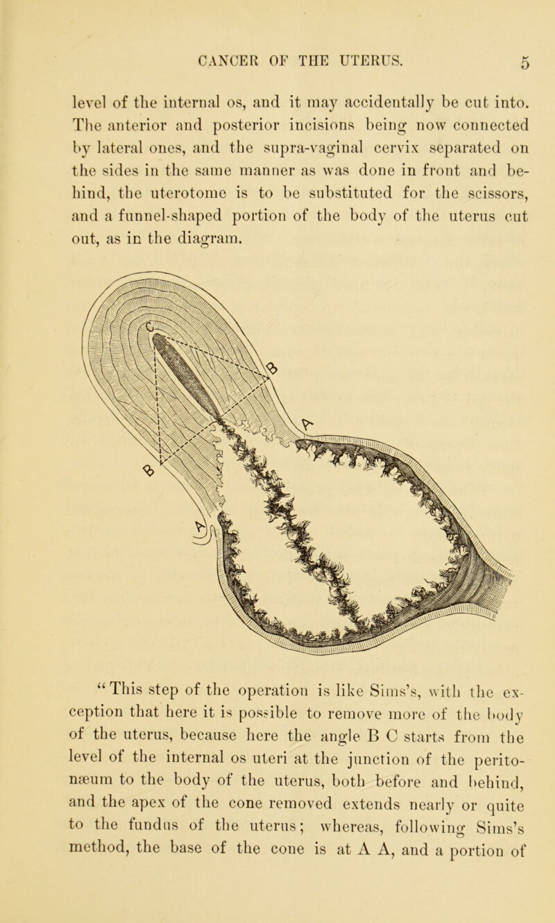 level of the internal os, and it may accidentally be cut into. The anterior and posterior incisions being now connected by lateral ones, and the supra-vaginal cervix separated on the sides in the same manner as was done in front and be- hind, the uterotome is to be substituted for the scissors, and a funnel-shaped portion of the body of the uterus cut out, as in the diagram. “ This step of the operation is like Sims’s, with the ex- ception that here it is possible to remove more of the body of the uterus, because here the angle B C starts from the level of the internal os uteri at the junction of the perito- naeum to the body of the uterus, both before and behind, and the apex of the cone removed extends nearly or quite to the fundus of the uterus; whereas, following Sims’s method, the base of the cone is at A A, and a portion of