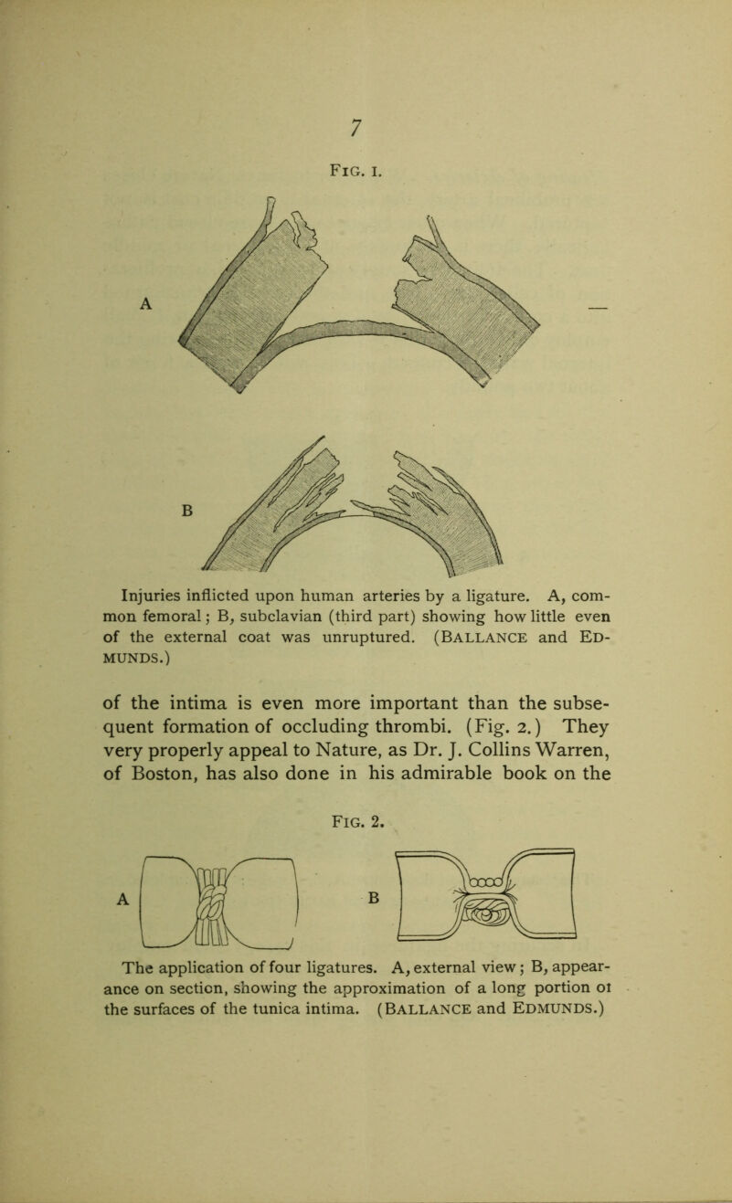 Fig. i. Injuries inflicted upon human arteries by a ligature. A, com- mon femoral; B, subclavian (third part) showing how little even of the external coat was unruptured. (BALLANCE and ED- MUNDS.) of the intima is even more important than the subse- quent formation of occluding thrombi. (Fig. 2.) They very properly appeal to Nature, as Dr. J. Collins Warren, of Boston, has also done in his admirable book on the Fig. 2. The application of four ligatures. A, external view; B, appear- ance on section, showing the approximation of a long portion oi the surfaces of the tunica intima. (Ballance and Edmunds.)