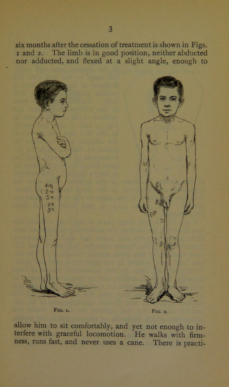 six months after the cessation of treatment is shown in Figs. I and 2. The limb is in good position, neither abducted nor adducted, and flexed at a slight angle, enough to Fig. 2. Fig. 1. allow him to sit comfortably, and yet not enough to in- terfere with graceful locomotion. He walks with firm- ness, runs fast, and never uses a cane. There is practi-