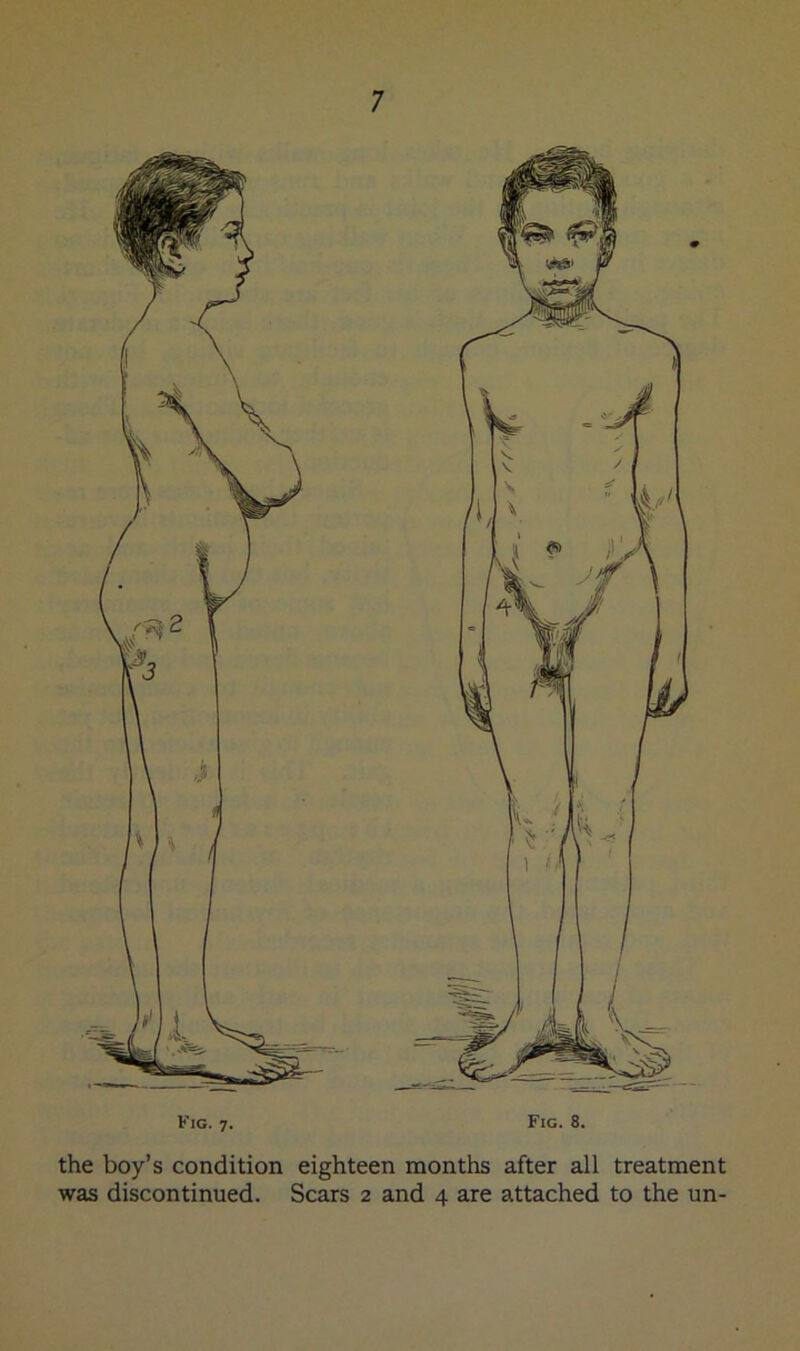 the boy’s condition eighteen months after all treatment was discontinued. Scars 2 and 4 are attached to the un-